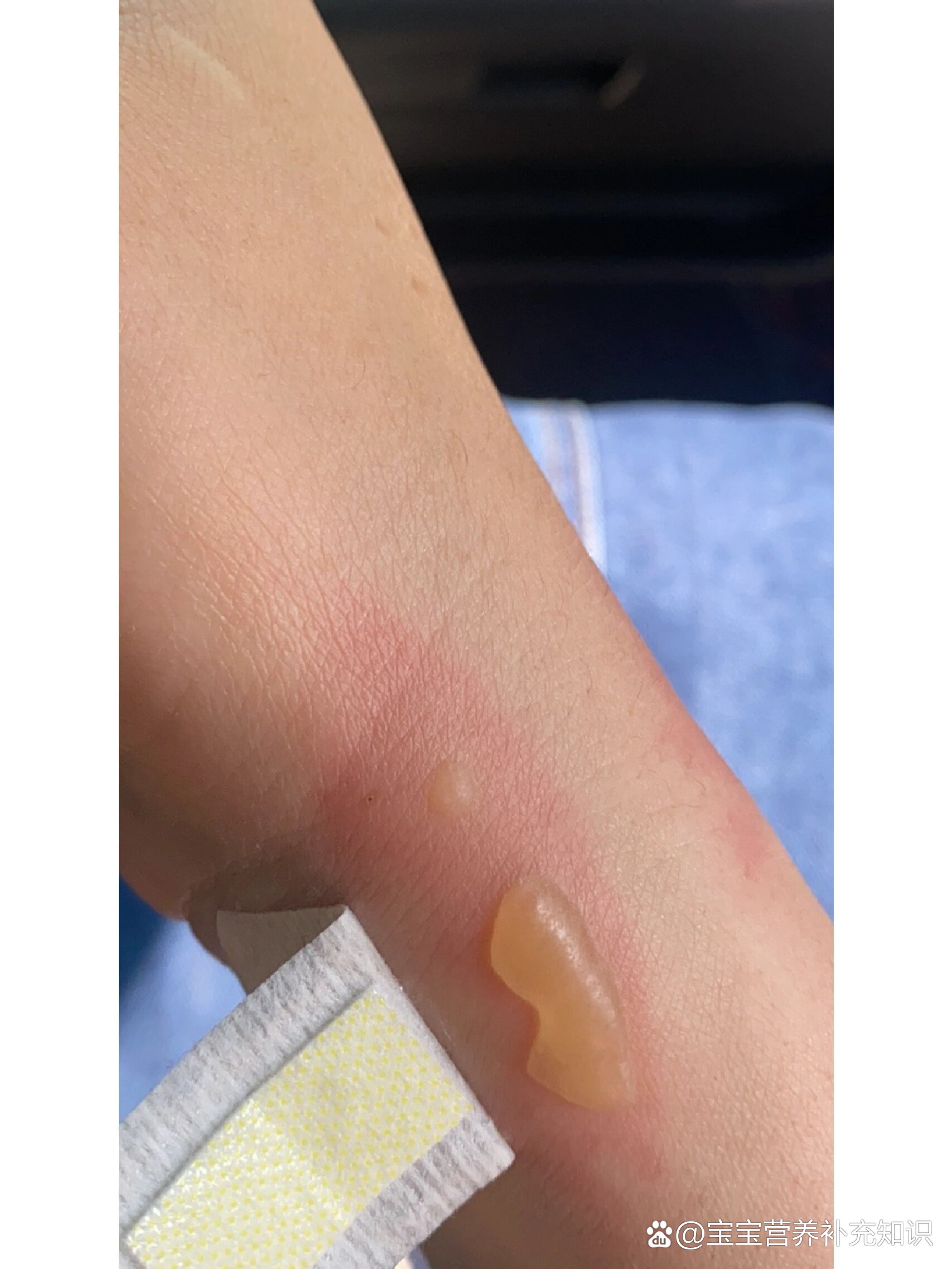 暖宝宝烫伤了,水泡要挑开吗?