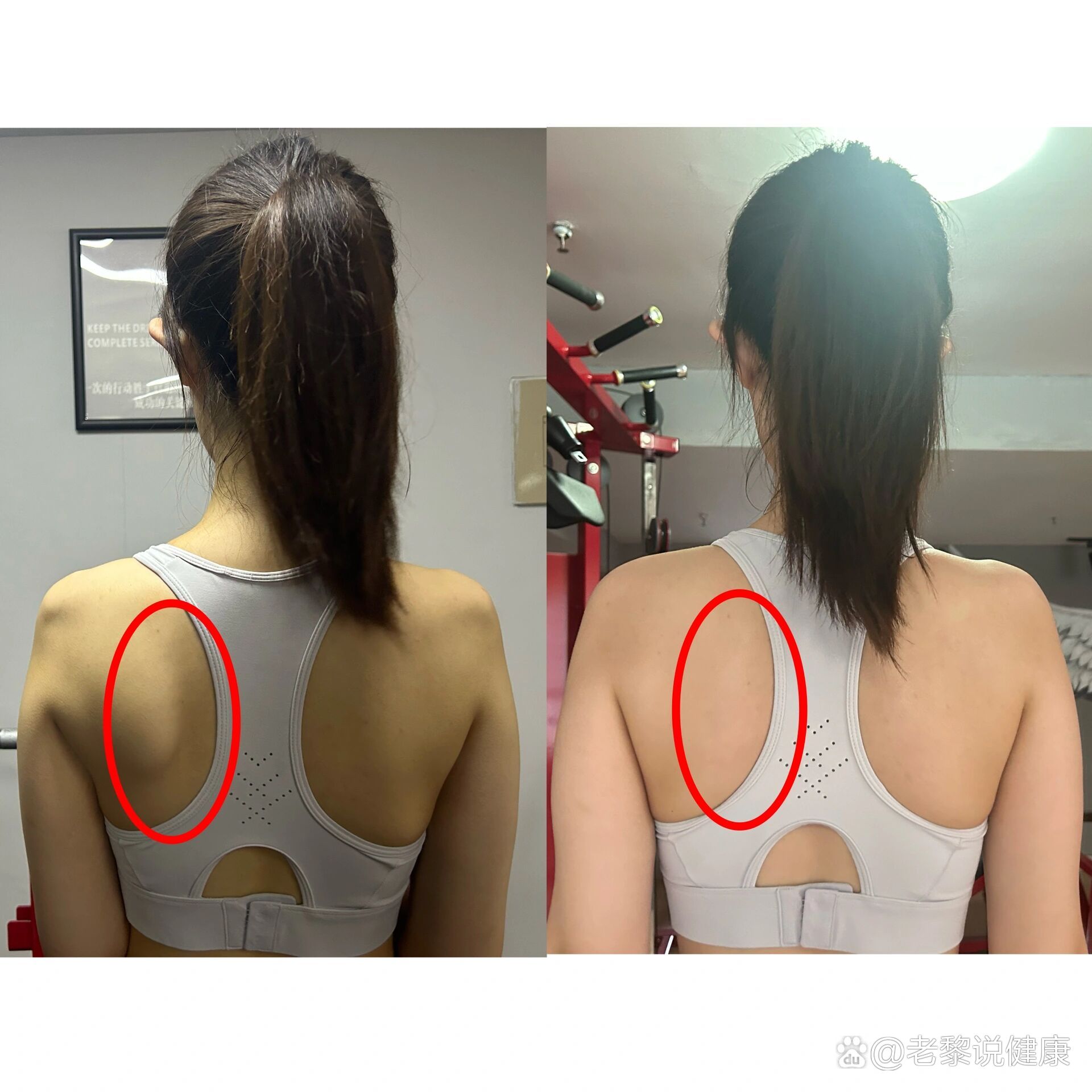 翼状肩胛骨不见了