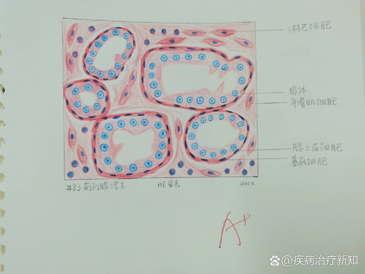 乙脑病理红蓝铅笔图图片