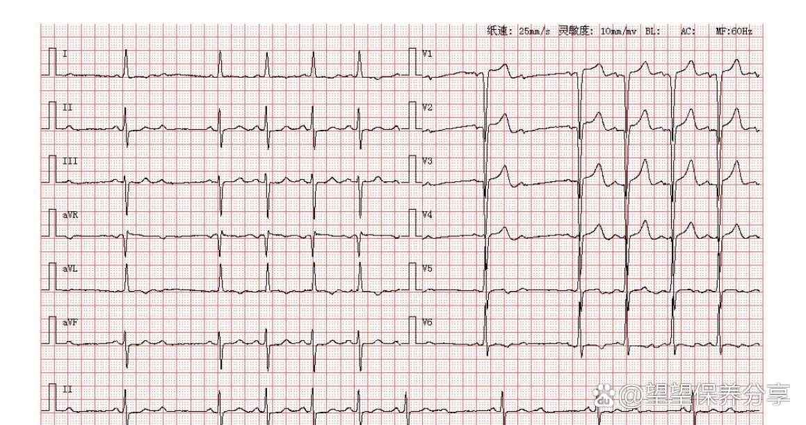 异常q波心电图怎么看图片