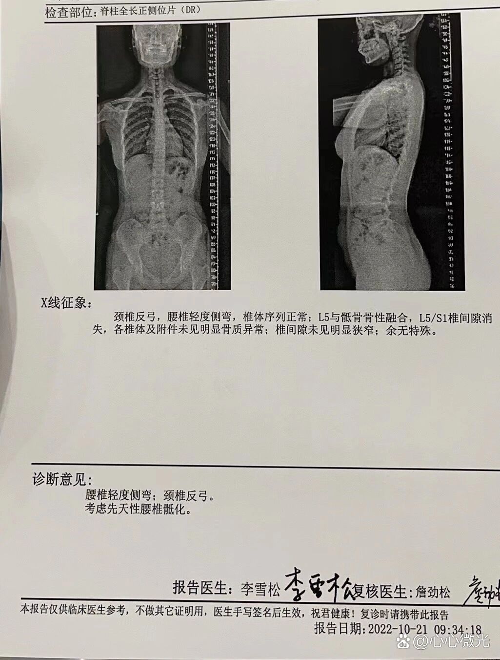 腰椎轻度侧弯图片