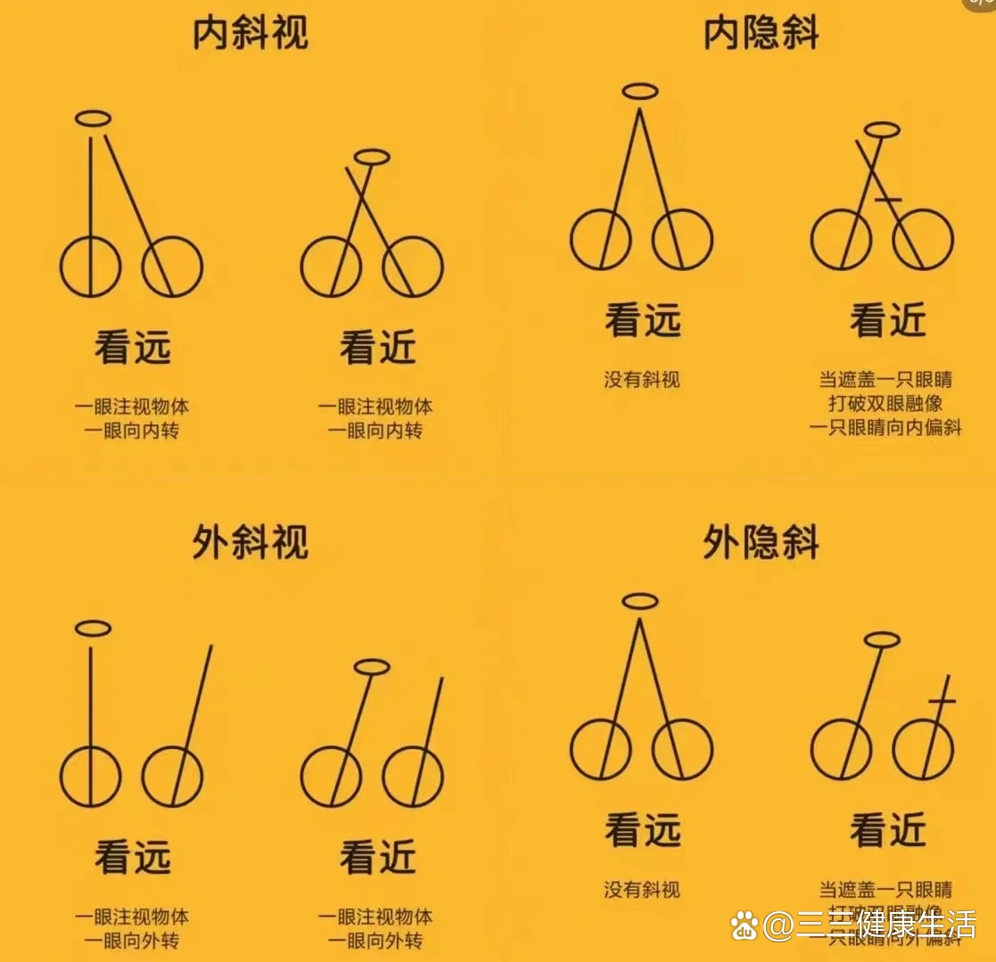 一张图,让你分清斜视