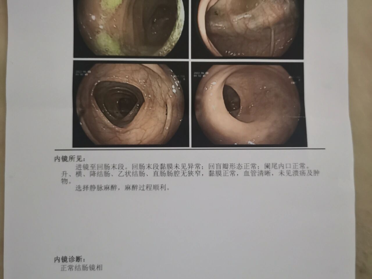 肠镜阑尾开口正常图片图片