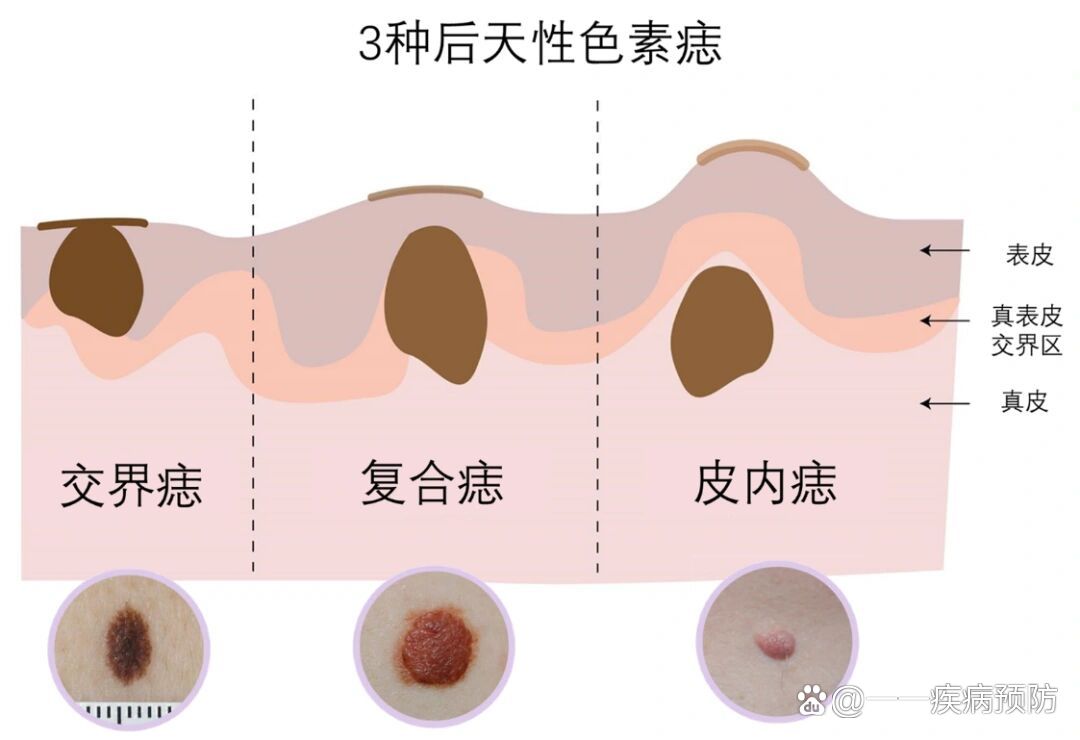 黑毛痣的危害图片