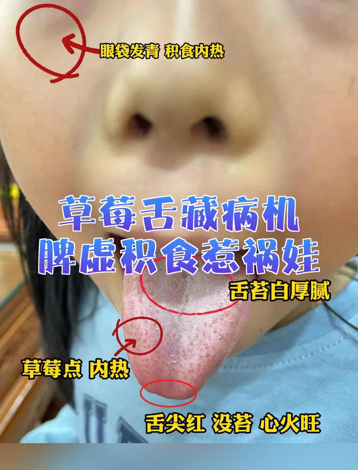 草莓舌藏病机，脾虚积食惹祸娃🔥