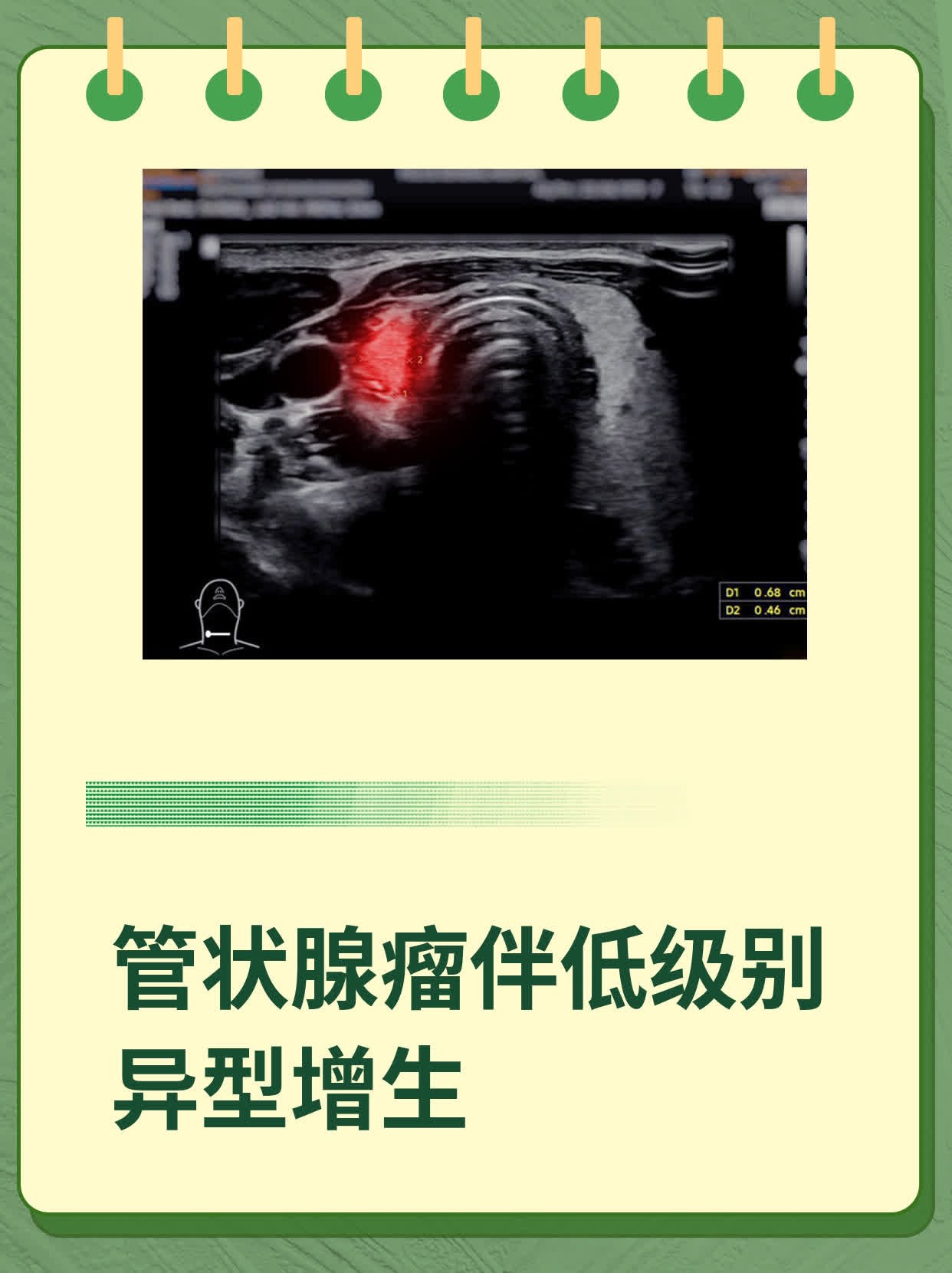 管状腺瘤伴低级别异型增生