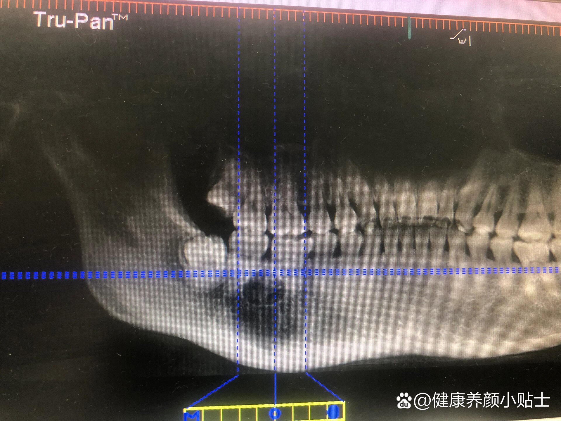 下颌骨ct图片