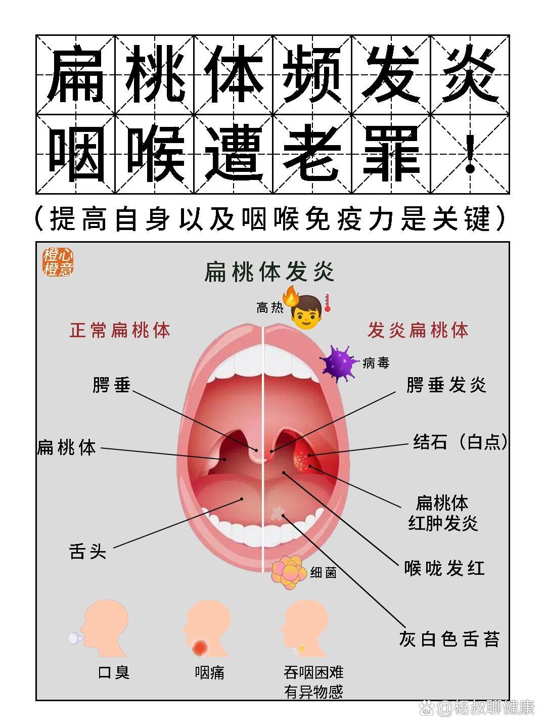 腭扁桃体咽扁桃体图片