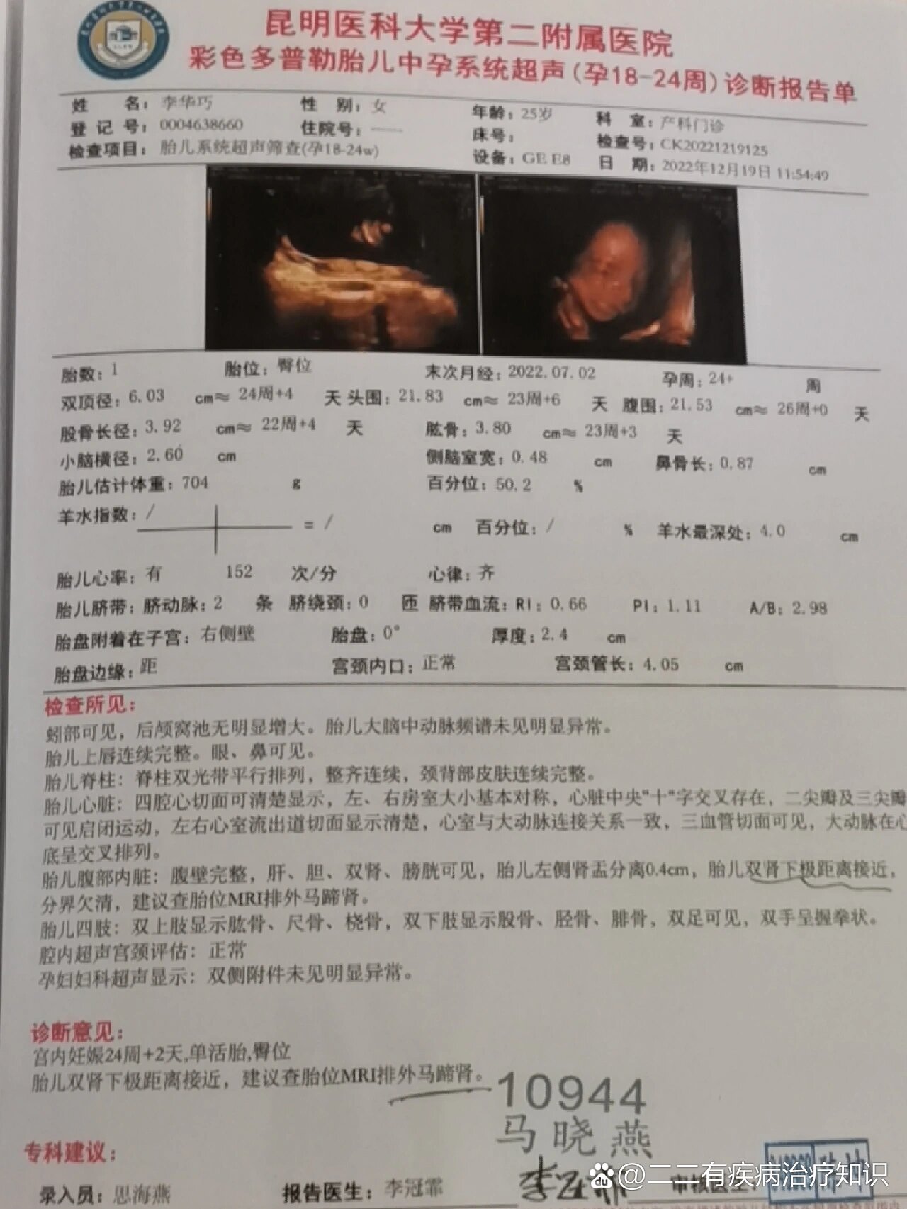 24周 2天马蹄肾