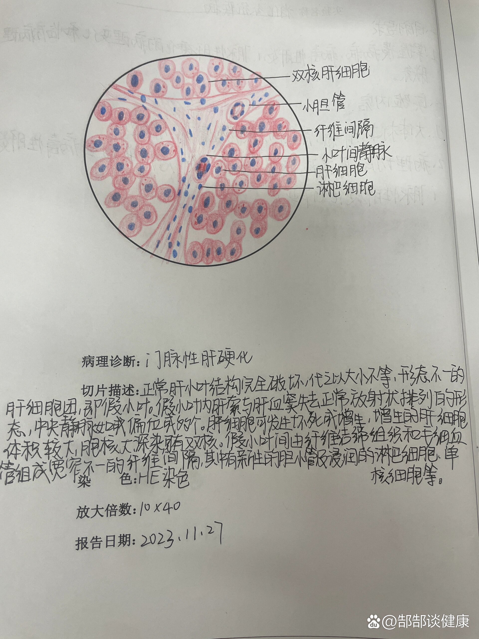 肝硬化假小叶手绘图图片