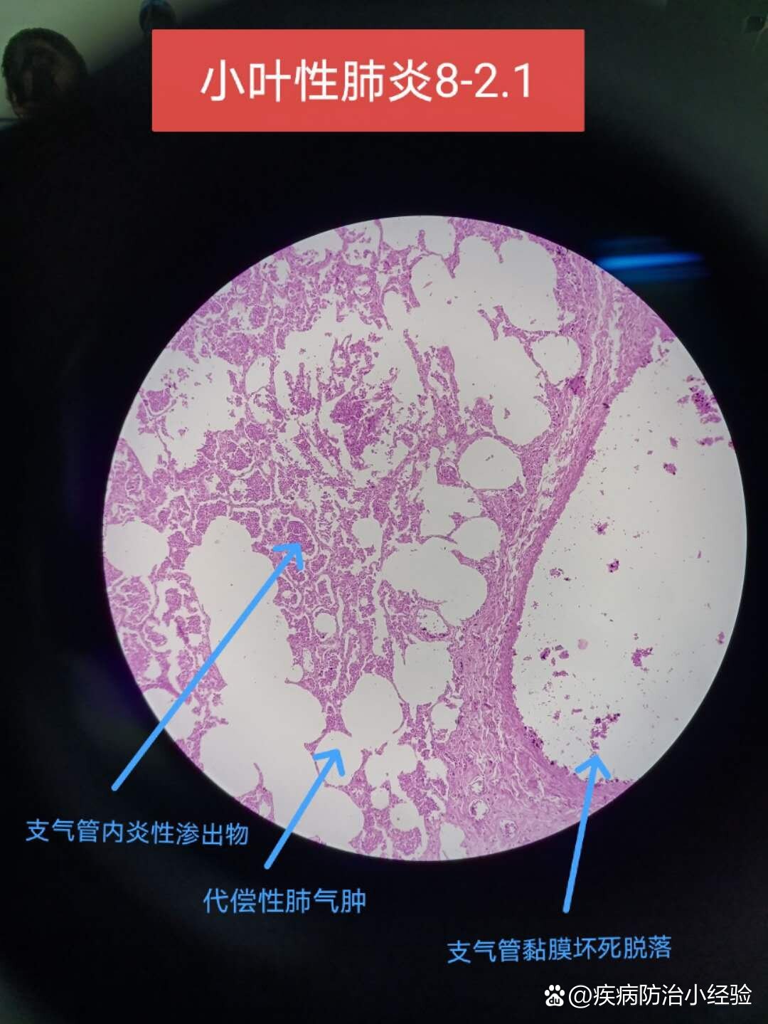 肺脓肿病理图图片