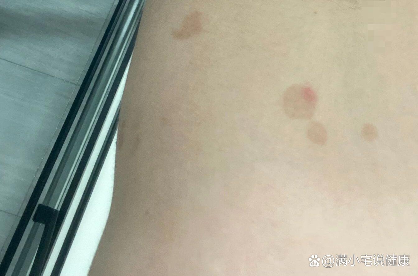 莫名其妙长汗斑