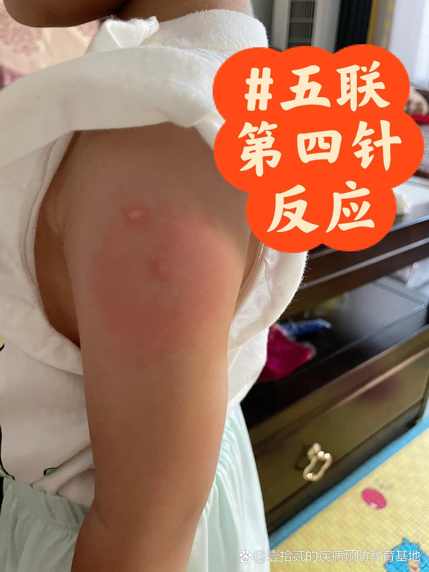  p>五联第四针打完第二天针眼周边红肿 br>之前打疫苗只出现过发烧的