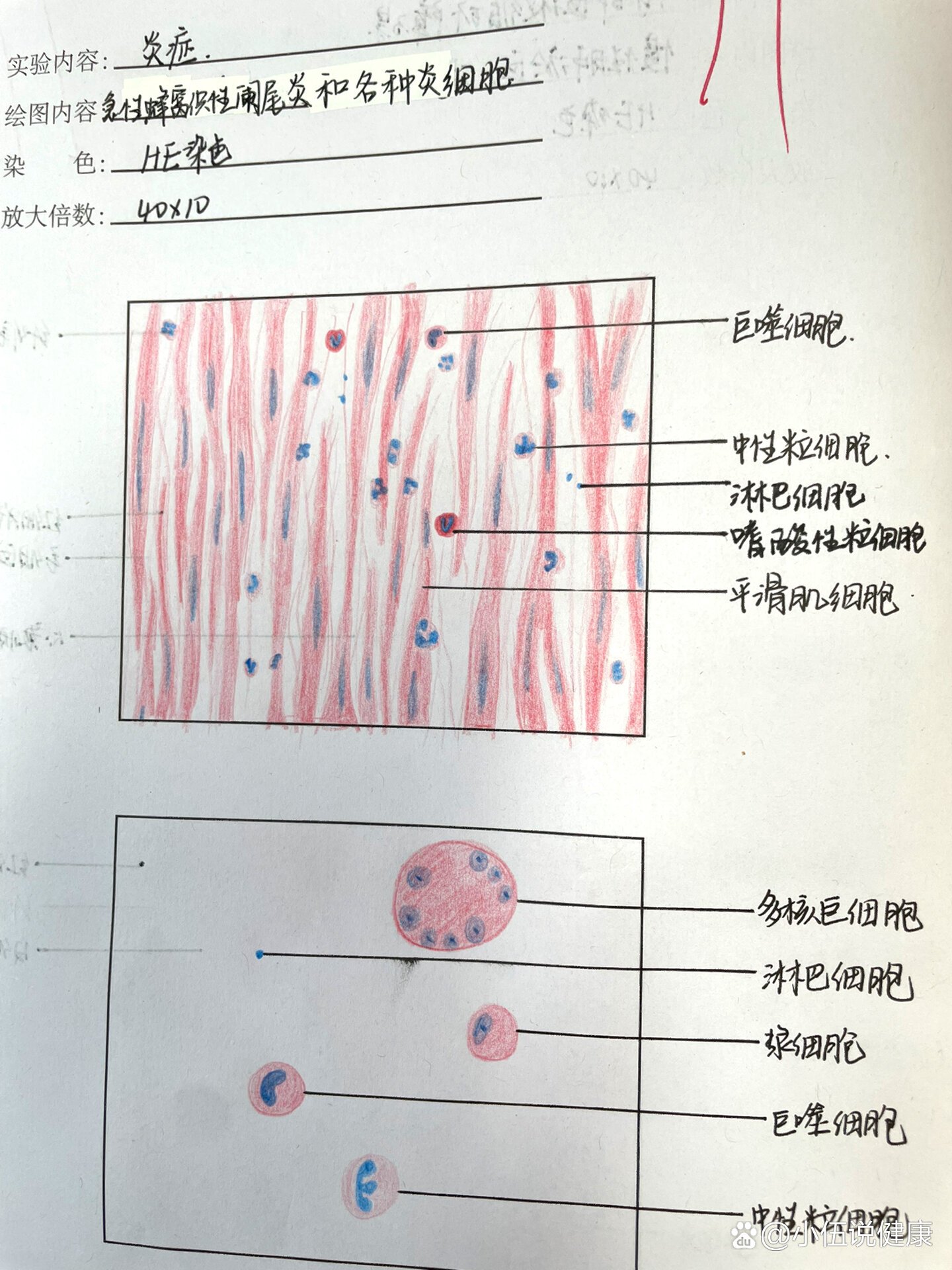 病理实验阑尾炎手绘图图片