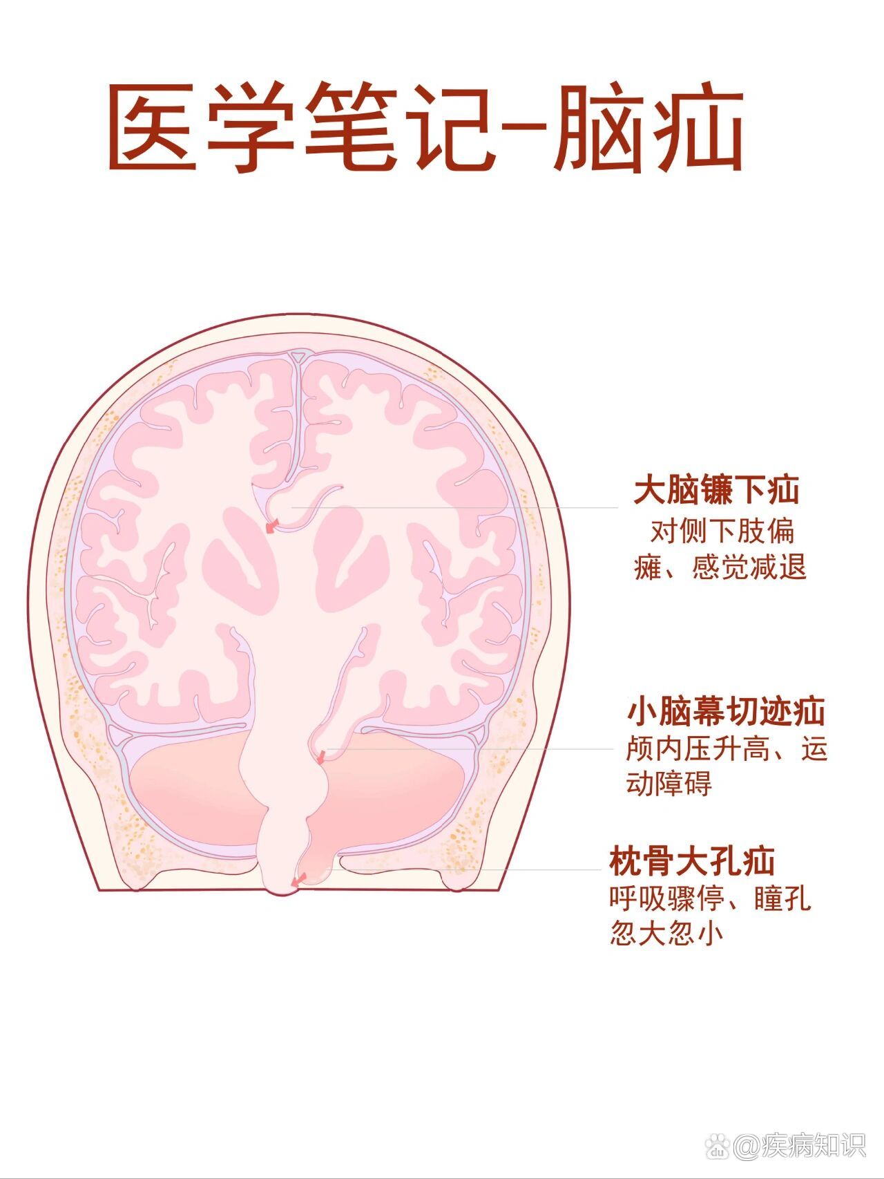 枕骨大孔疝临床表现图片