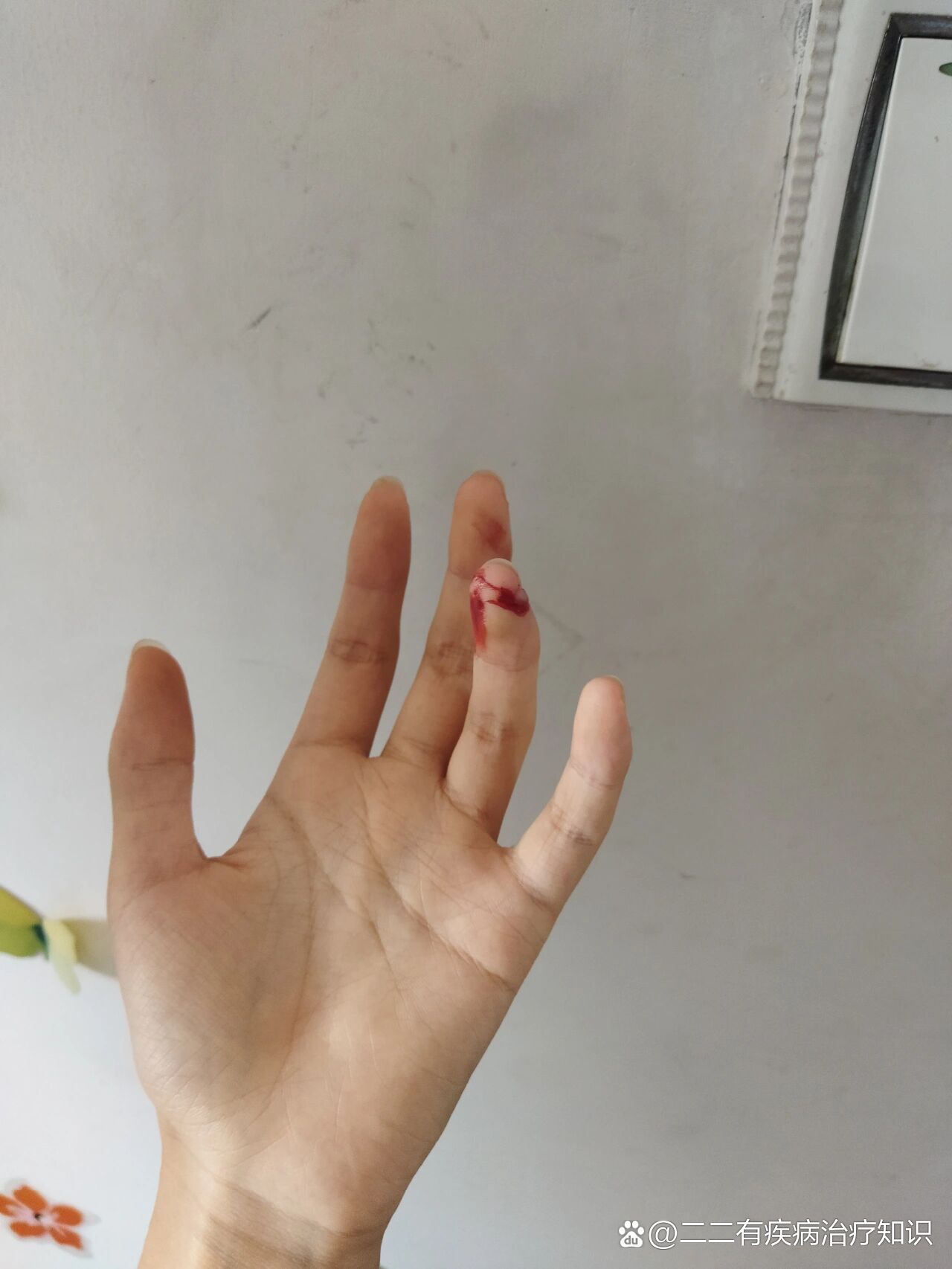记录手指割破愈合day1