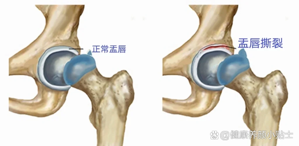 髋关节关节唇图片