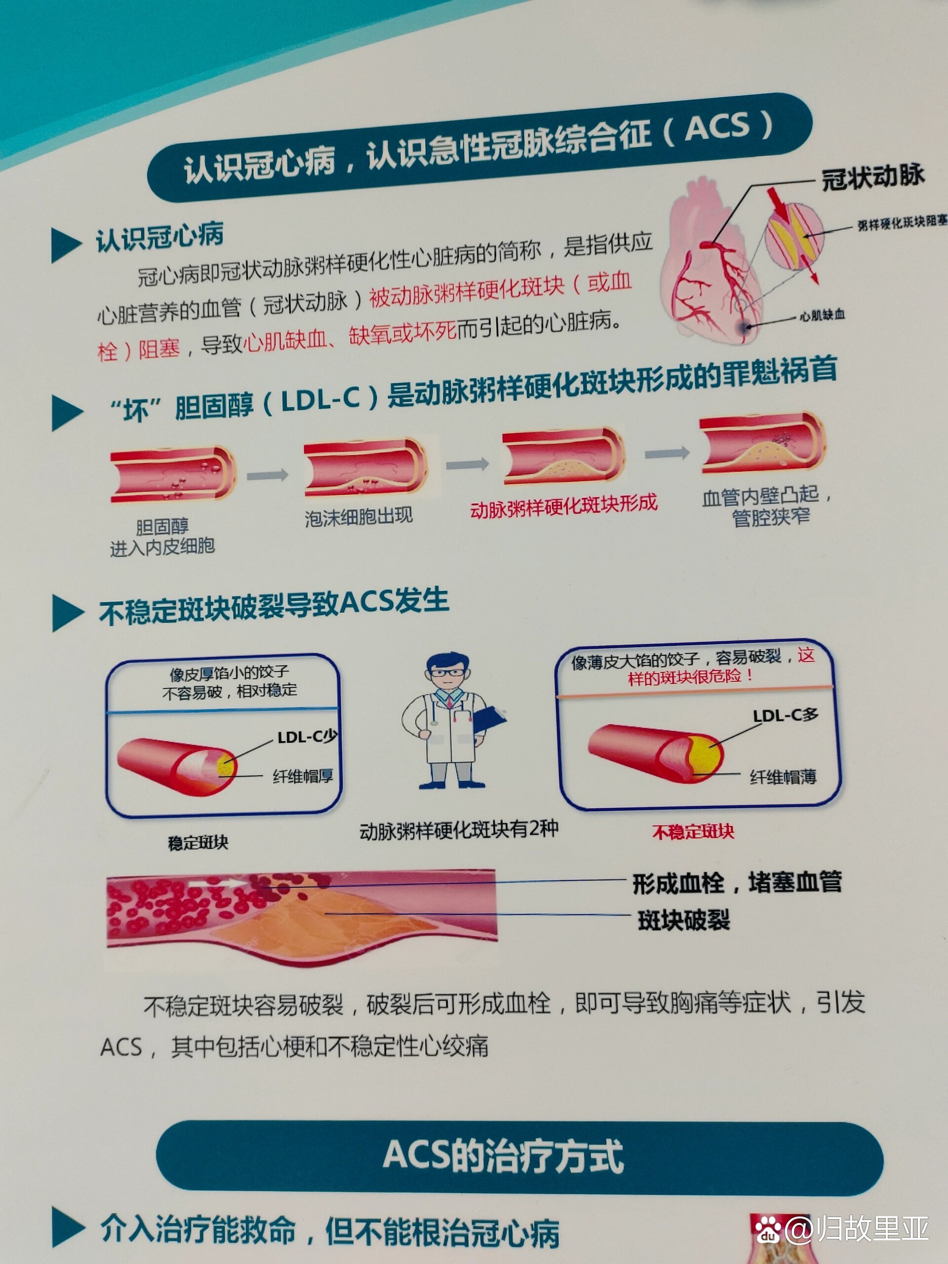 美国禁止使用心脏支架图片