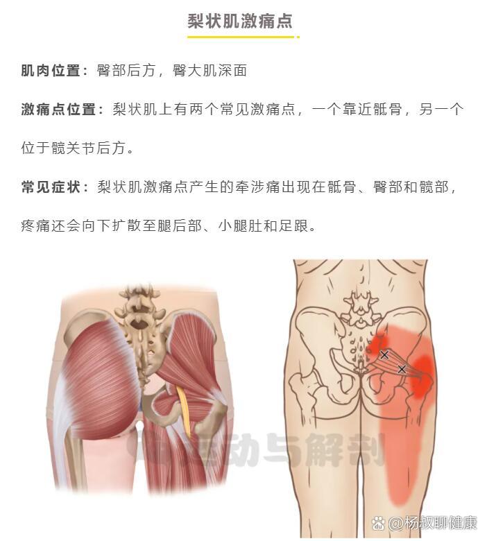 并不是所有臀部和腿后部疼痛都叫坐骨神经痛