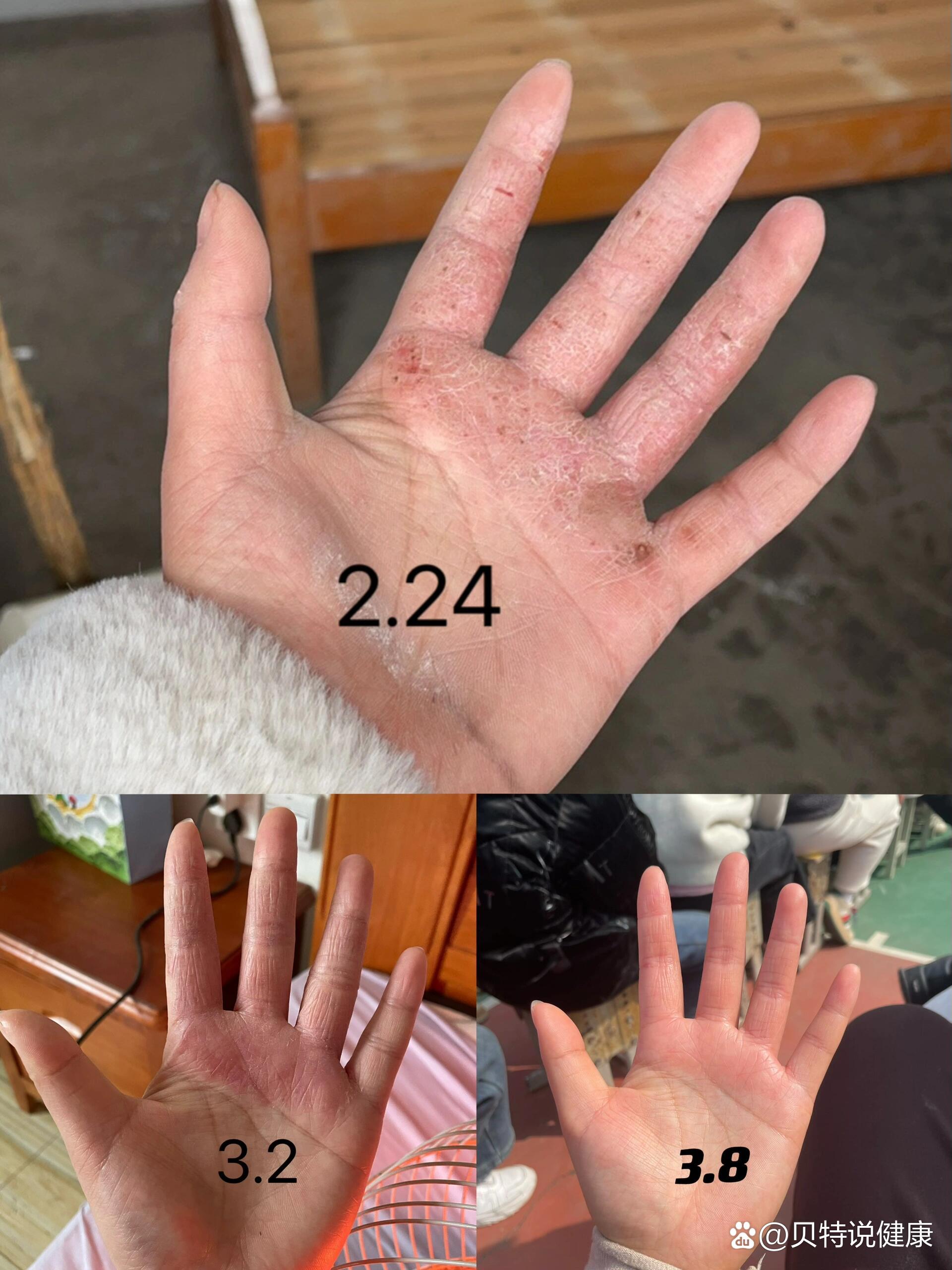 汗疹子,疹子,小疹子(第2页)_大山谷图库