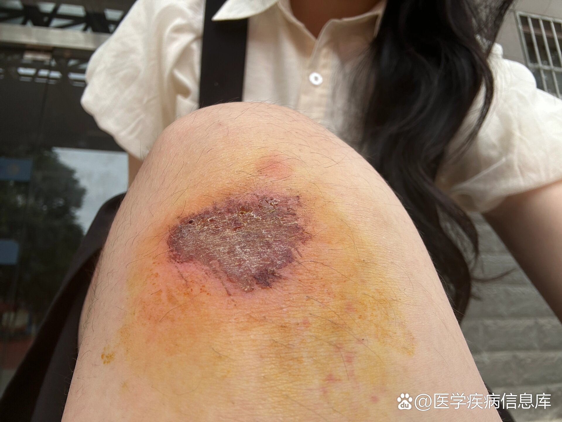  p>结痂之后可以碰水了吗 br>试骑9315擦伤了,第四天结痂是这样子