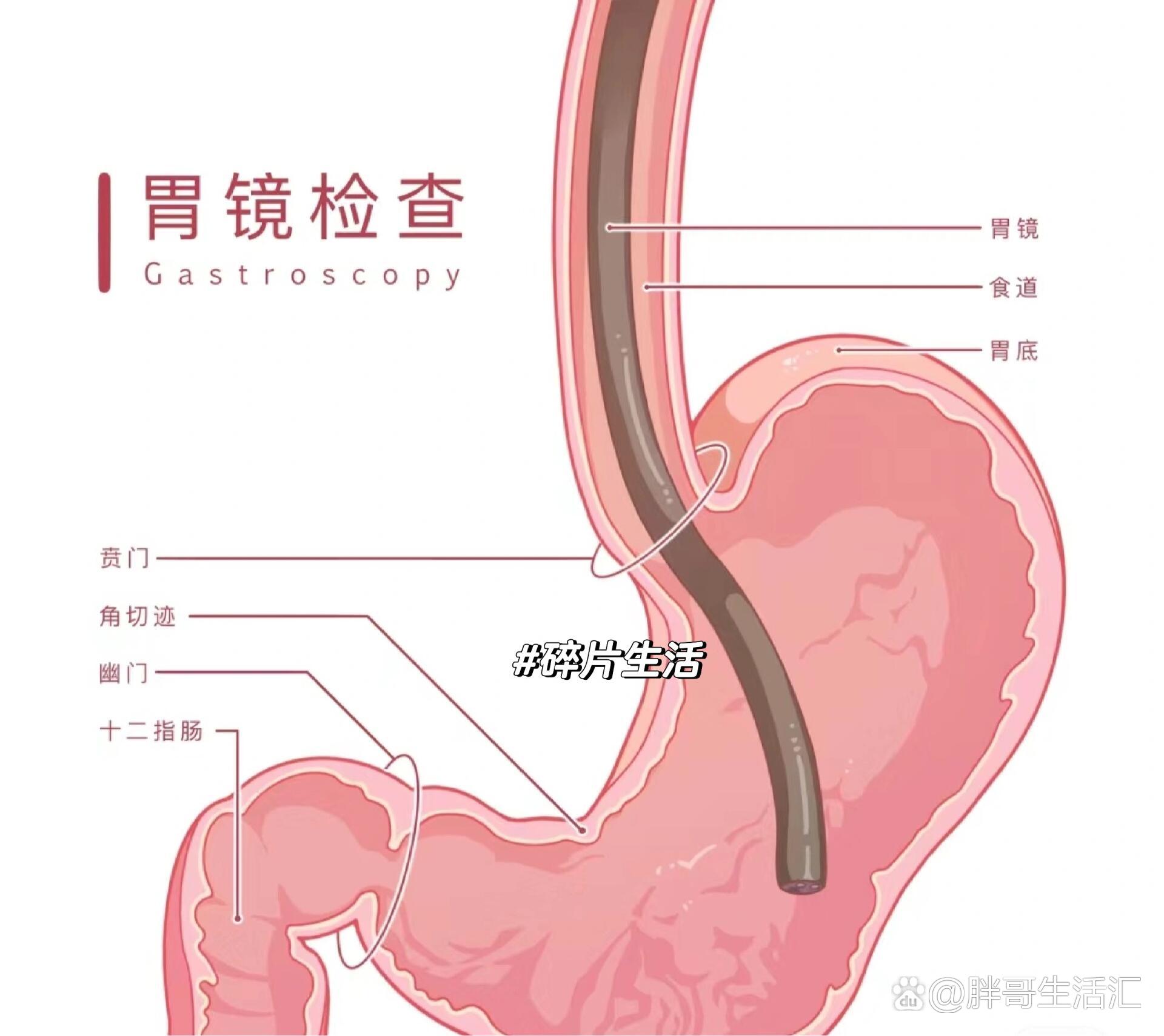 做胃镜太痛苦了