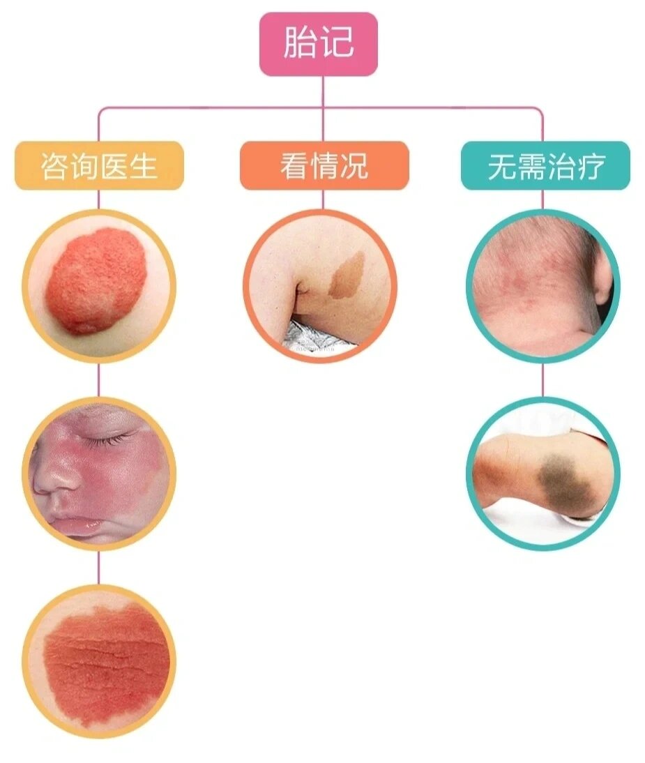 别不管小时候的胎记