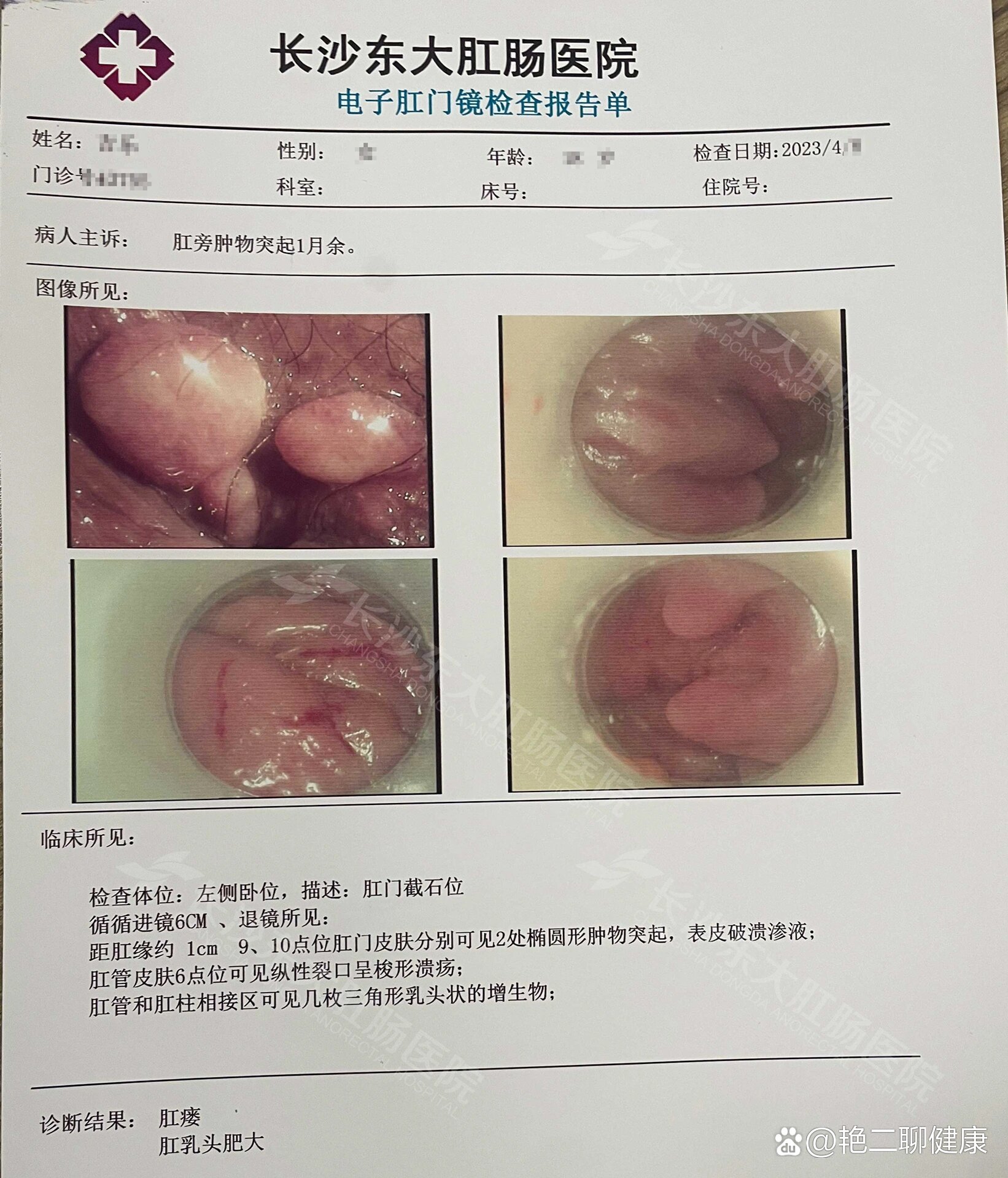 肛瘘治疗要多少钱图片