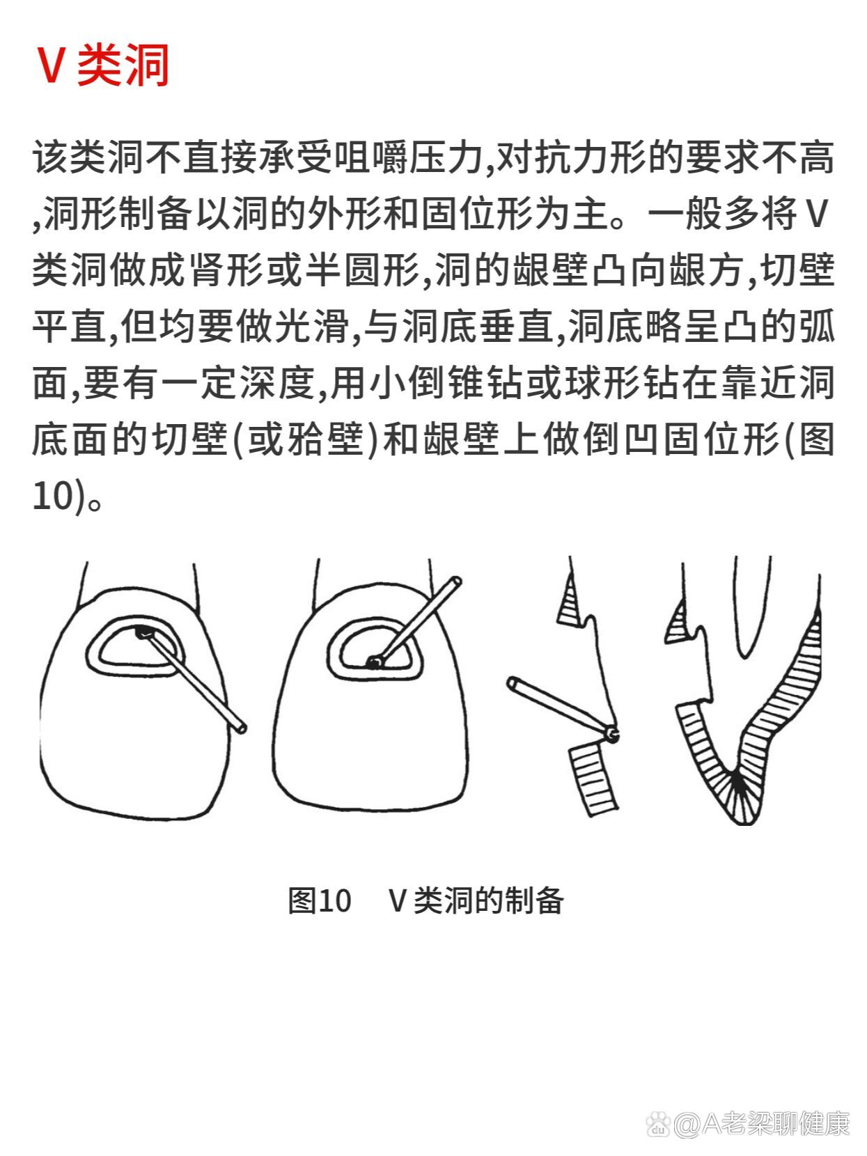 9215龋病51566类洞形制备要点6015