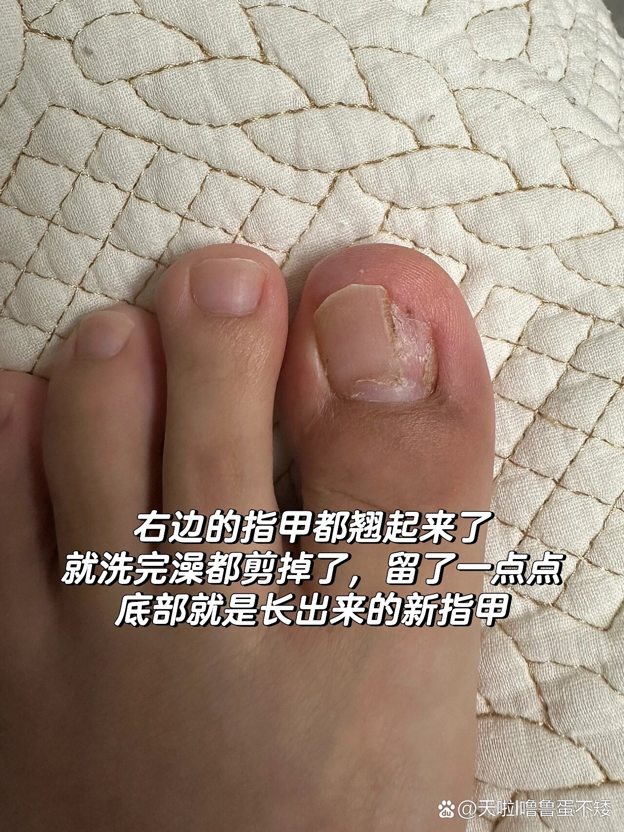 甲母痣手术后很丑吗图片