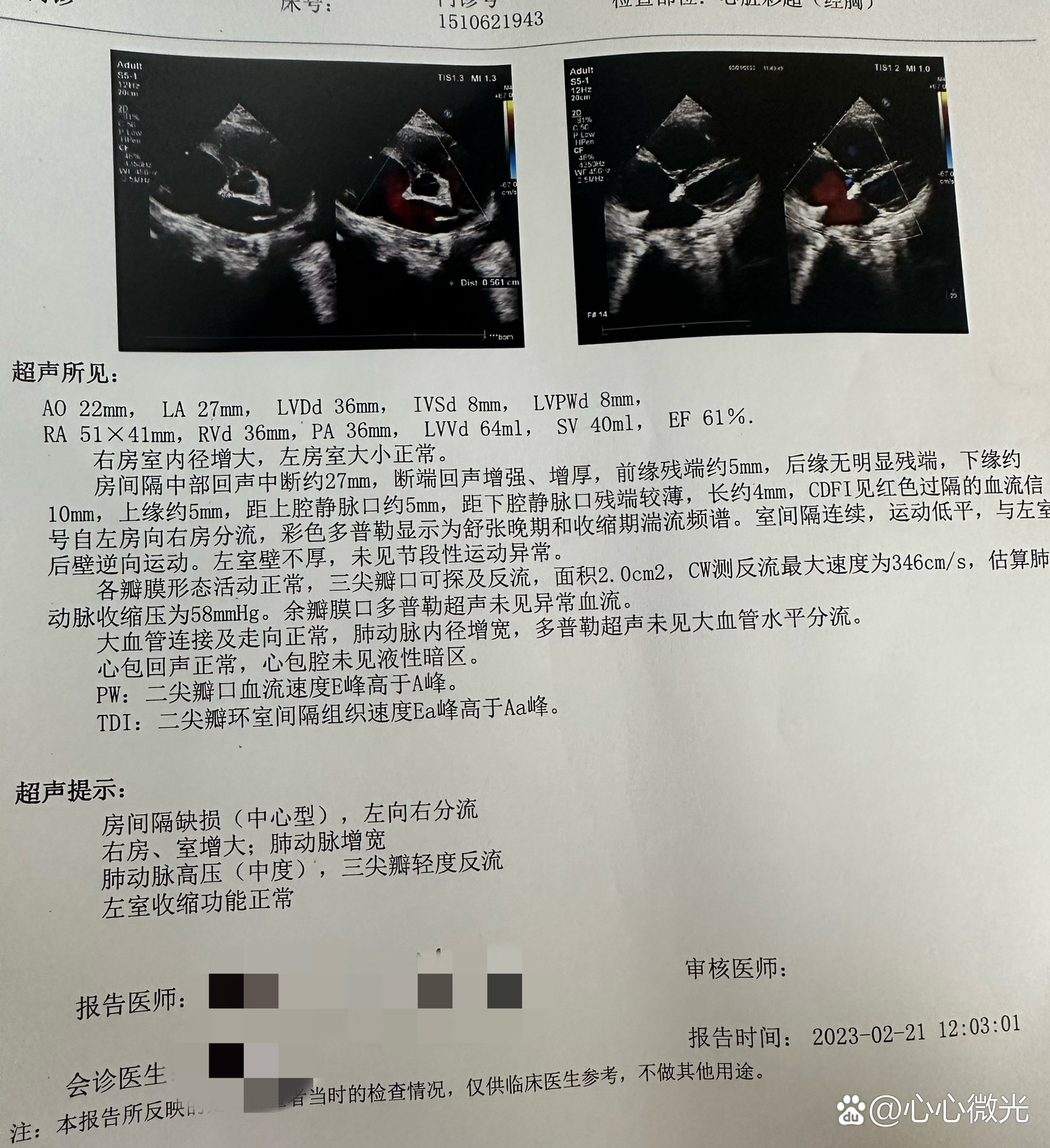 房间隔缺损