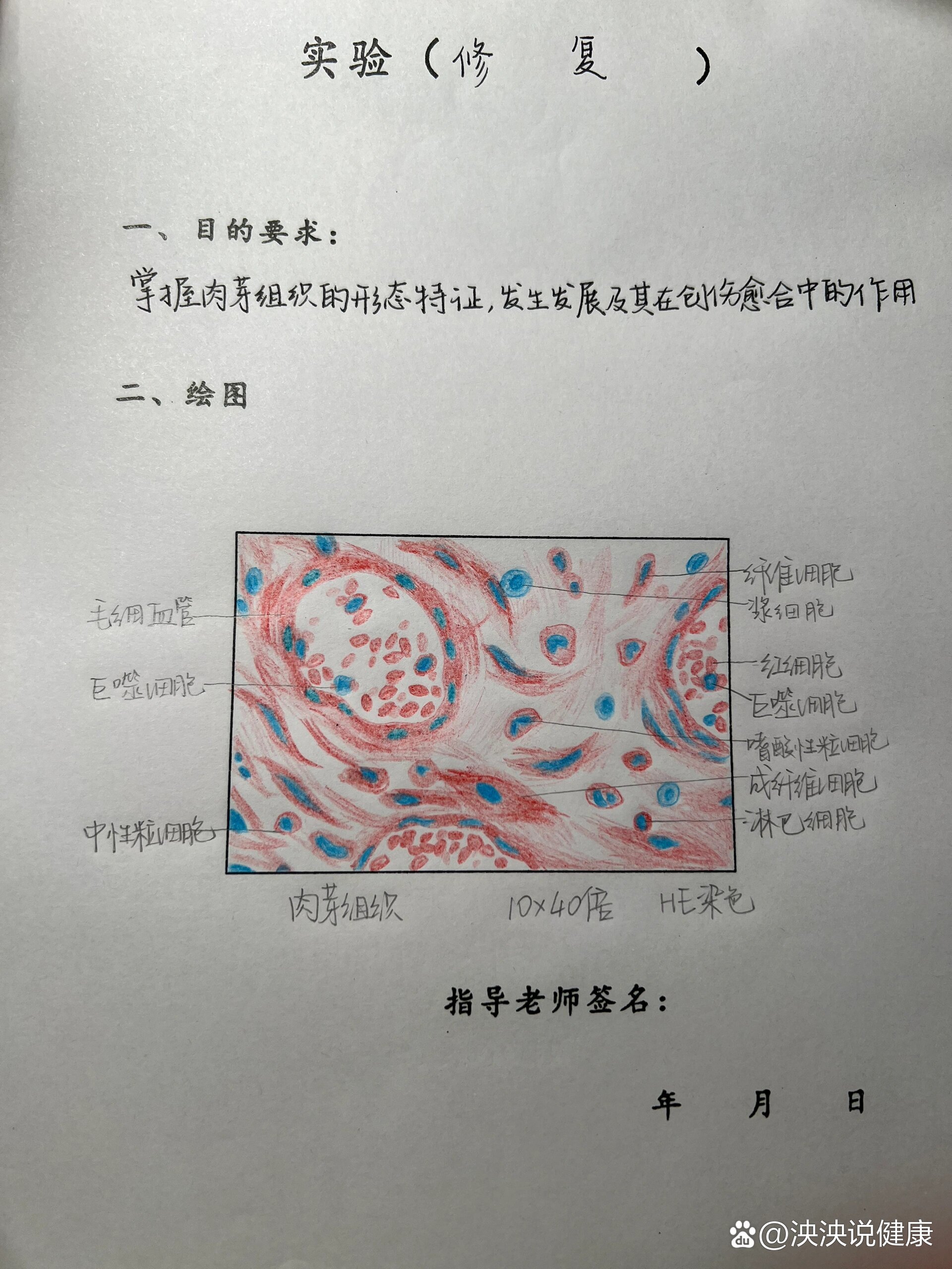 肉芽组织病变手绘图图片