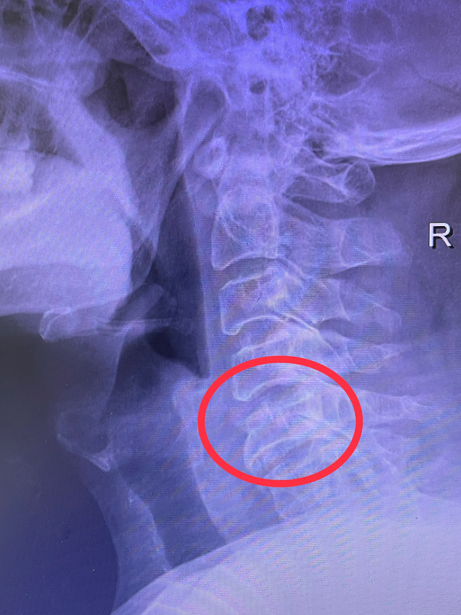 女子遇交通事故致颈椎骨折,综合性保守治疗即可恢复!