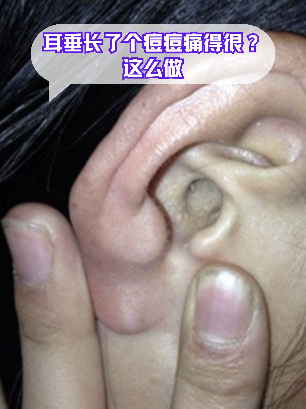 耳垂里长了个痘痘一捏就疼?试试这么做