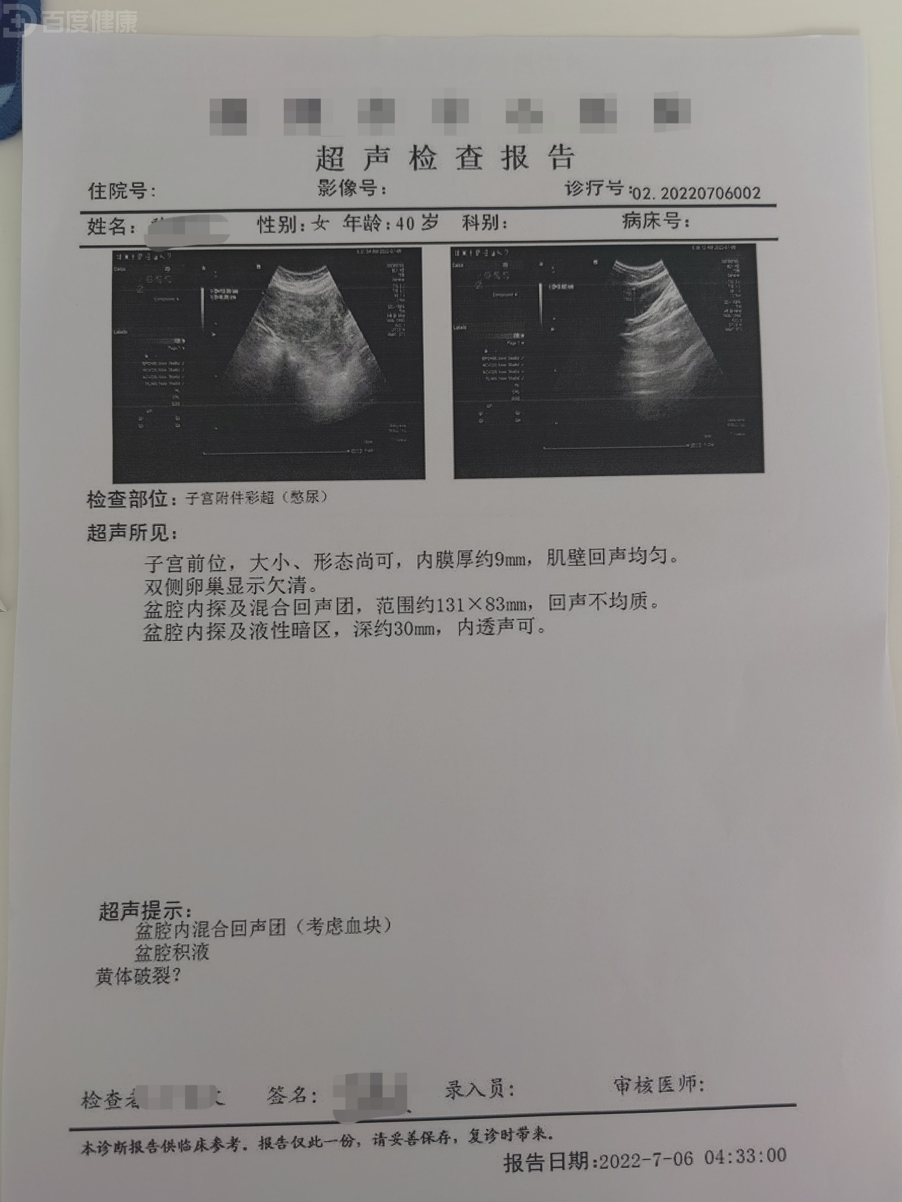 盆腔积液可以同房吗图片