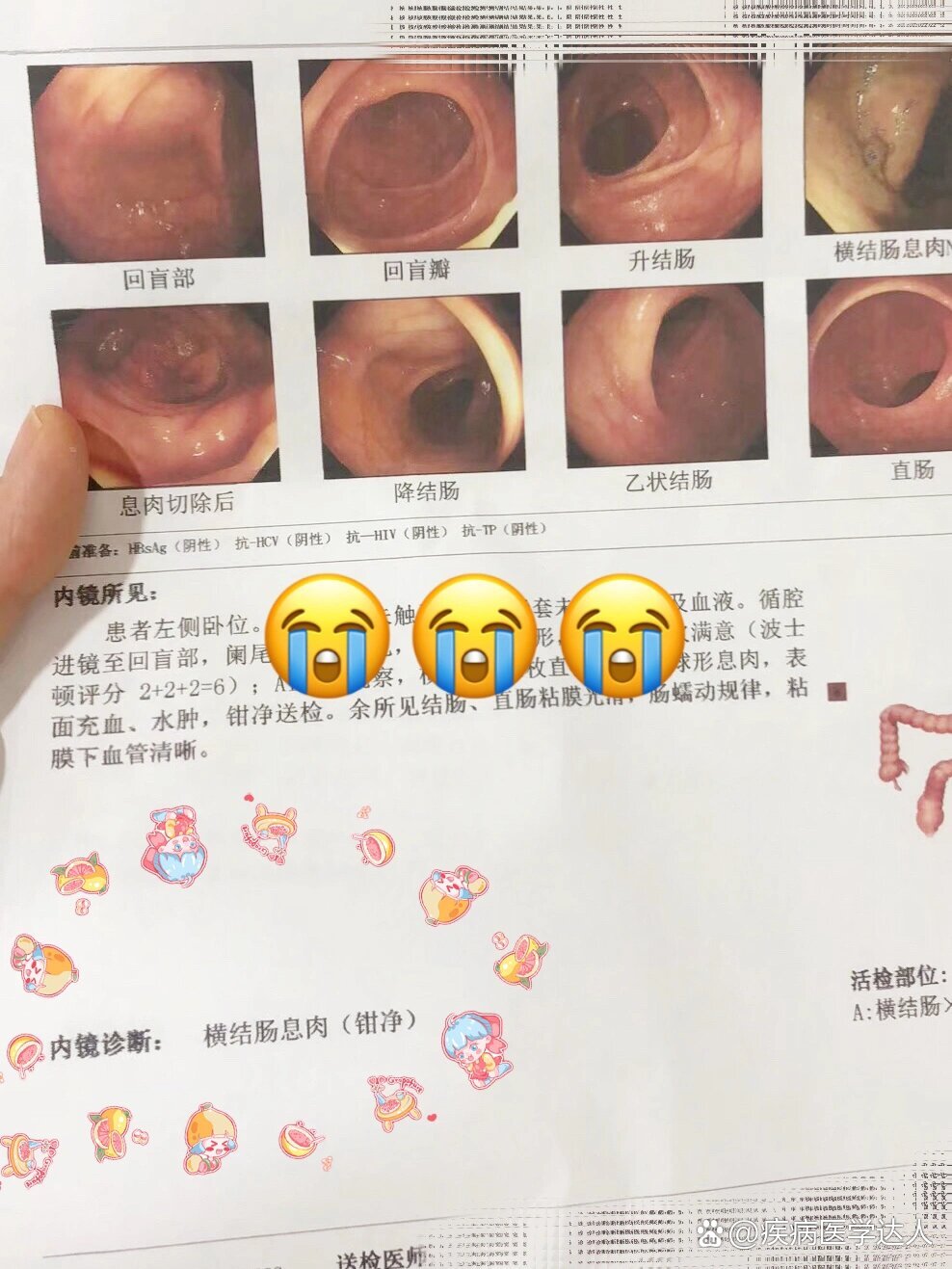 长期便秘的朋友建议都去检查!