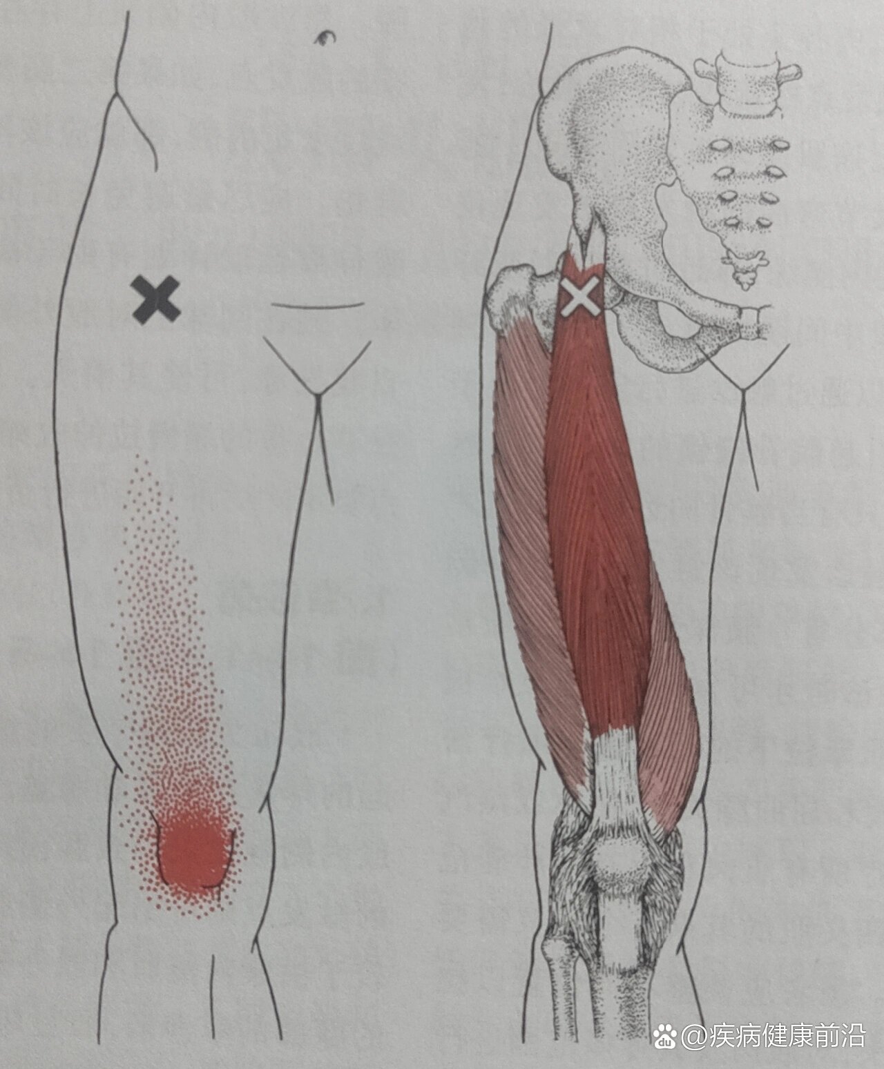 会导致膝关节疼痛的股直肌触发点