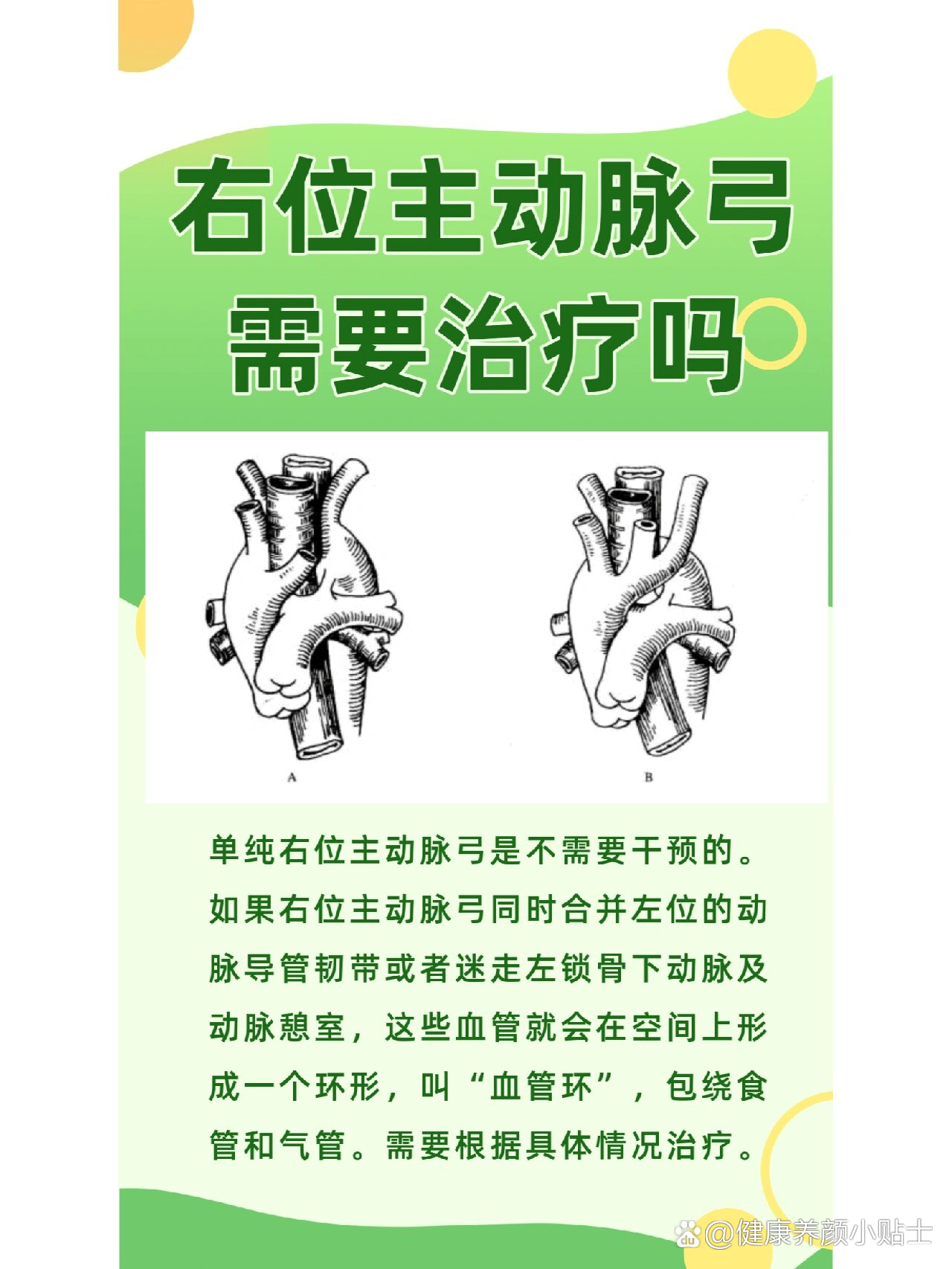 双主动脉弓图片图片