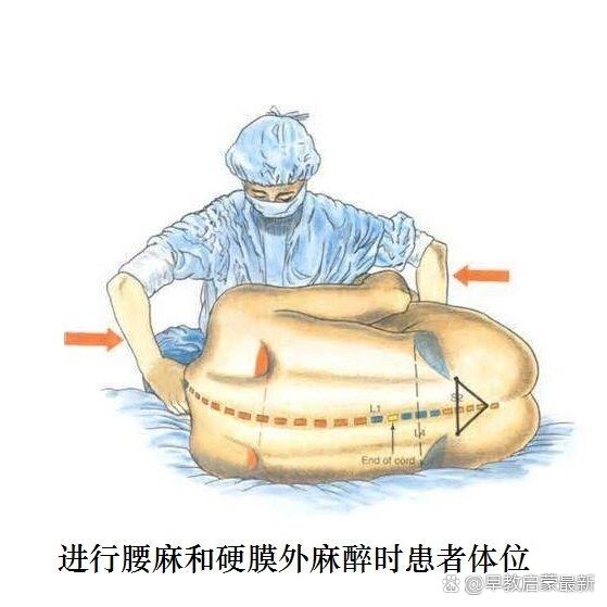 一般下肢,下腹部的手术都用它,比如剖宫产,顺产打无痛,痔疮,下肢骨折