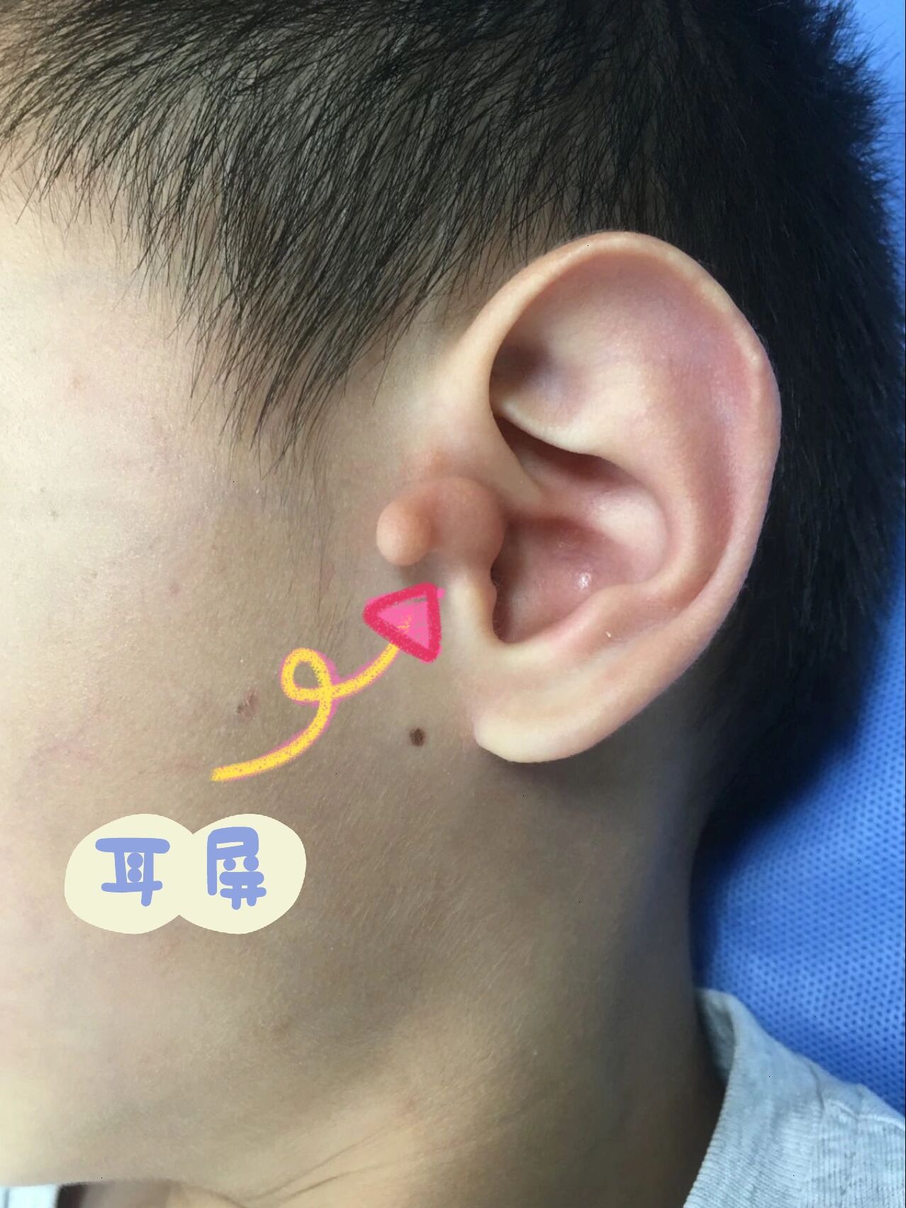 附耳切除有哪些注意事项?