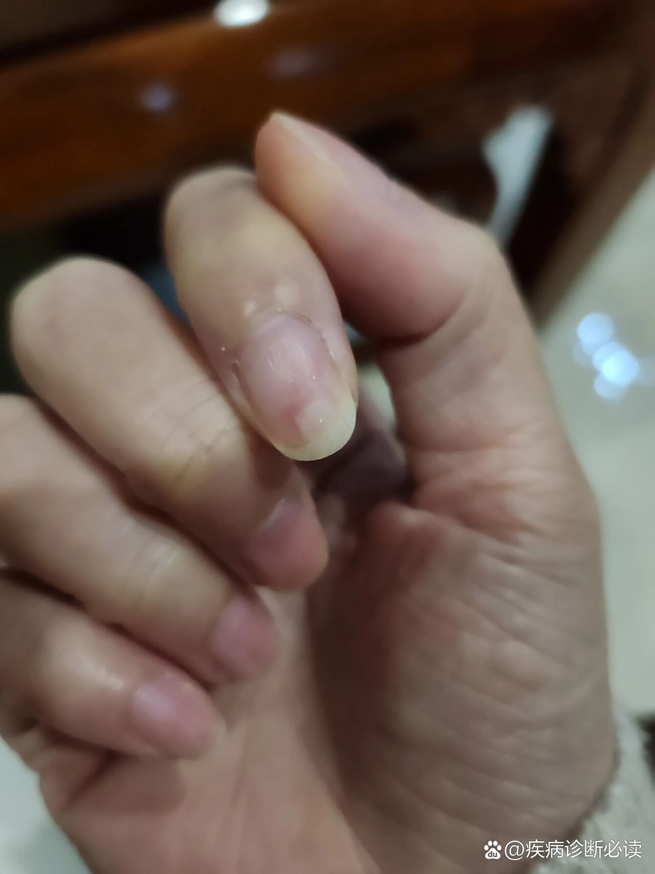 谁能告诉我甲肉分离要怎么样才能长好