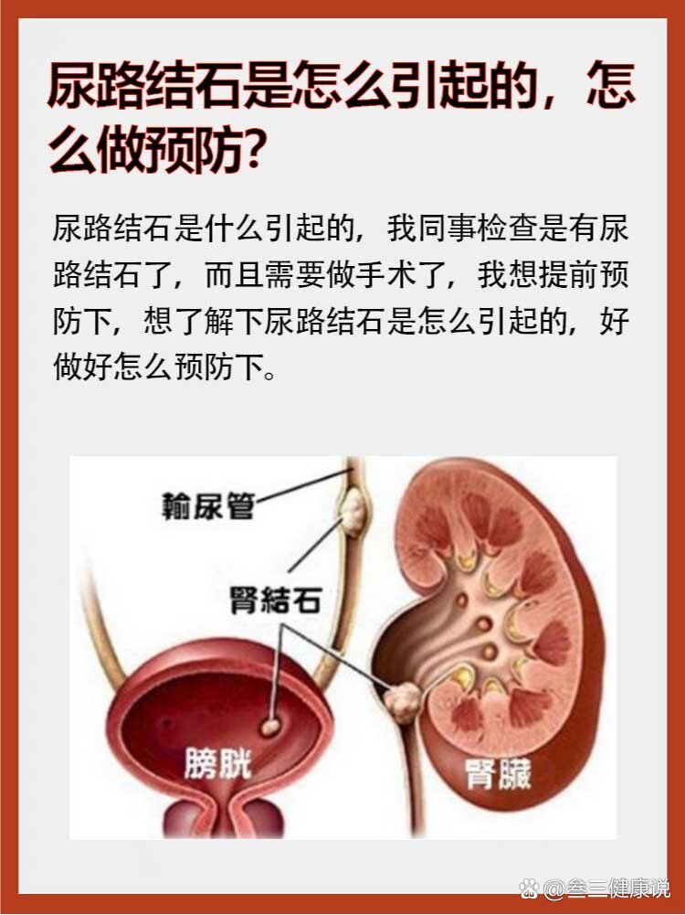 尿路结石怎么形成的图片