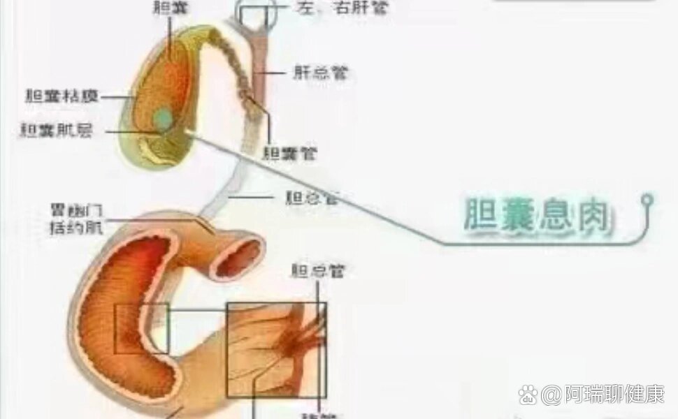 胆囊息肉有什么症状图片