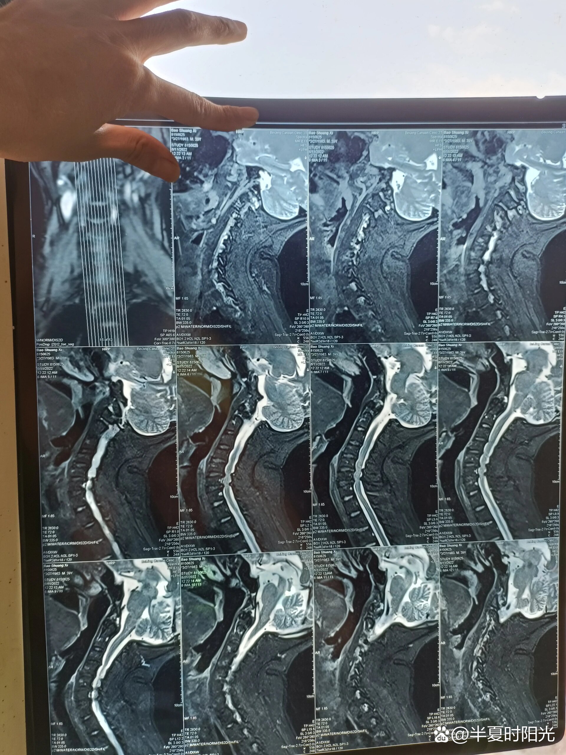 颈椎动力位核磁与平片核磁共振的对比