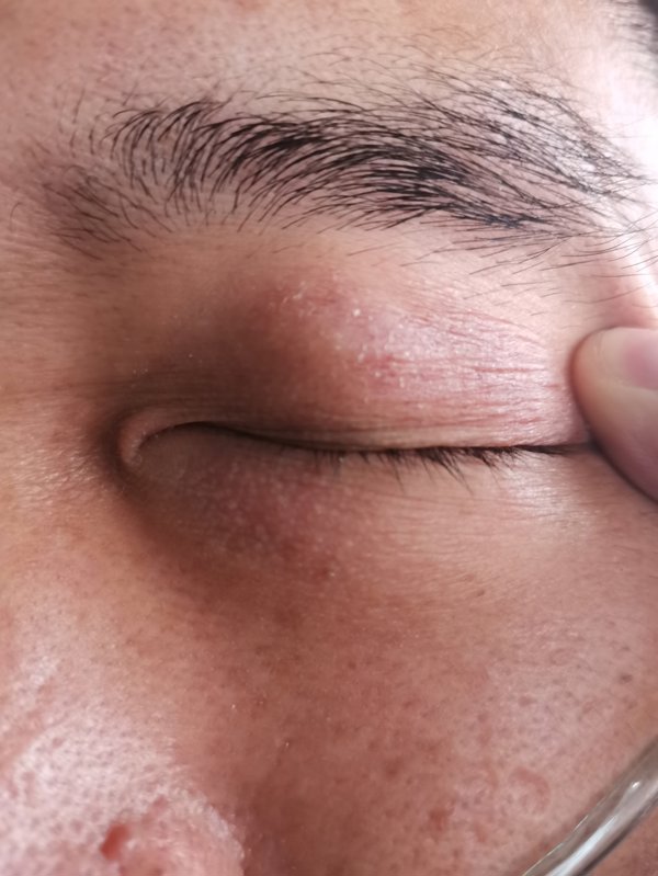 泪囊炎能挤出脓是不是快好了