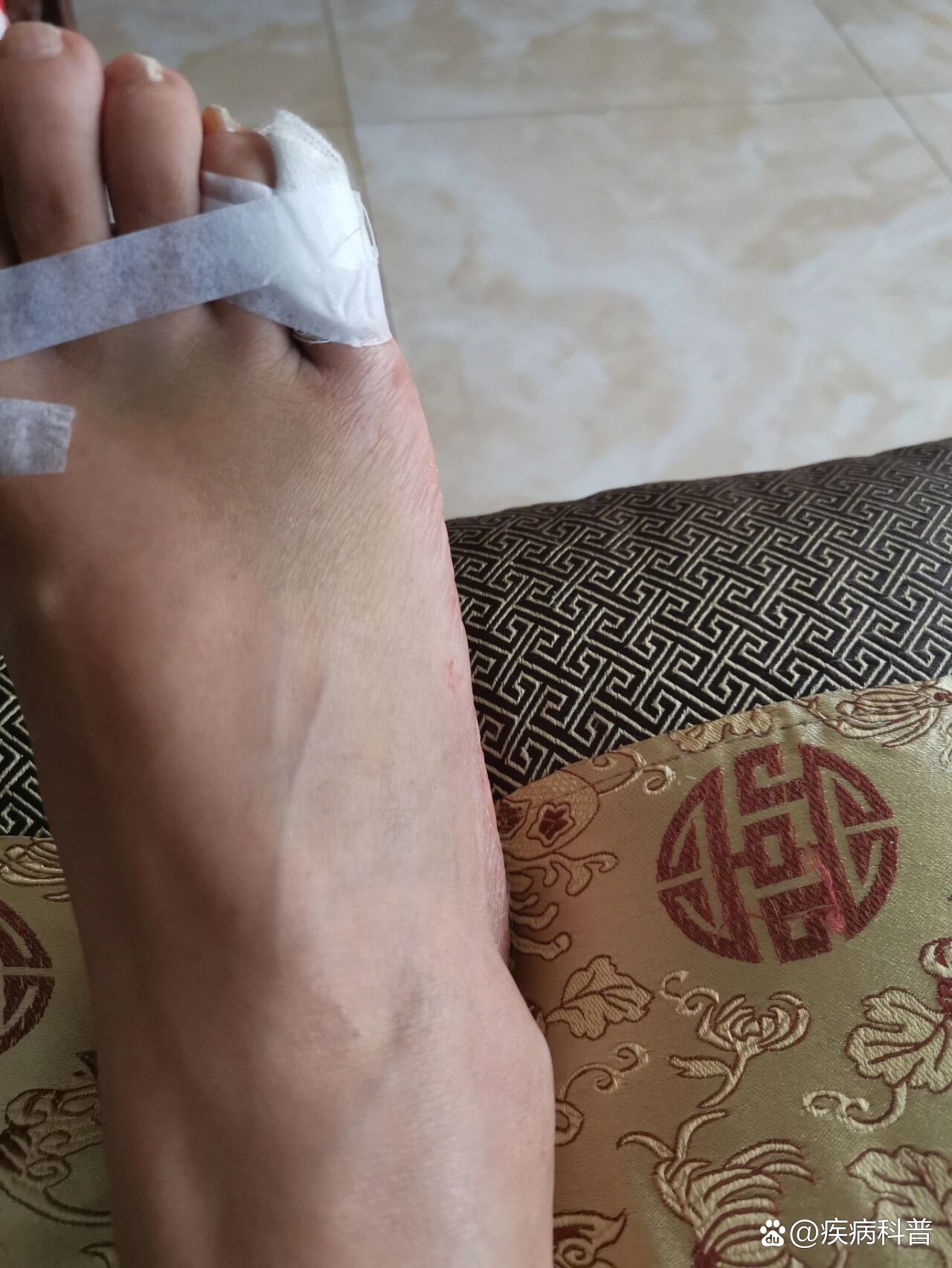 小脚趾骨折第10天,可以拄拐溜达几步了