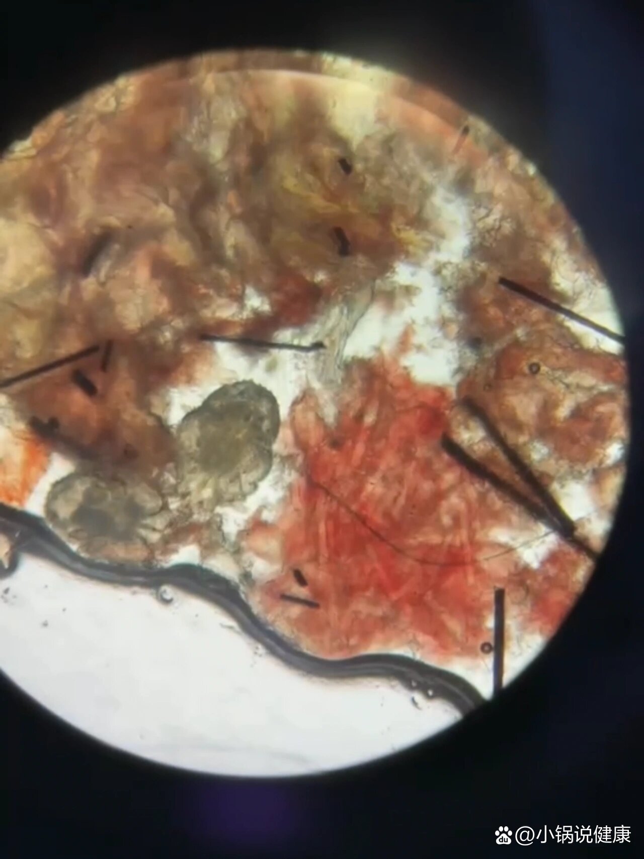 疥螨虫卵和疥螨