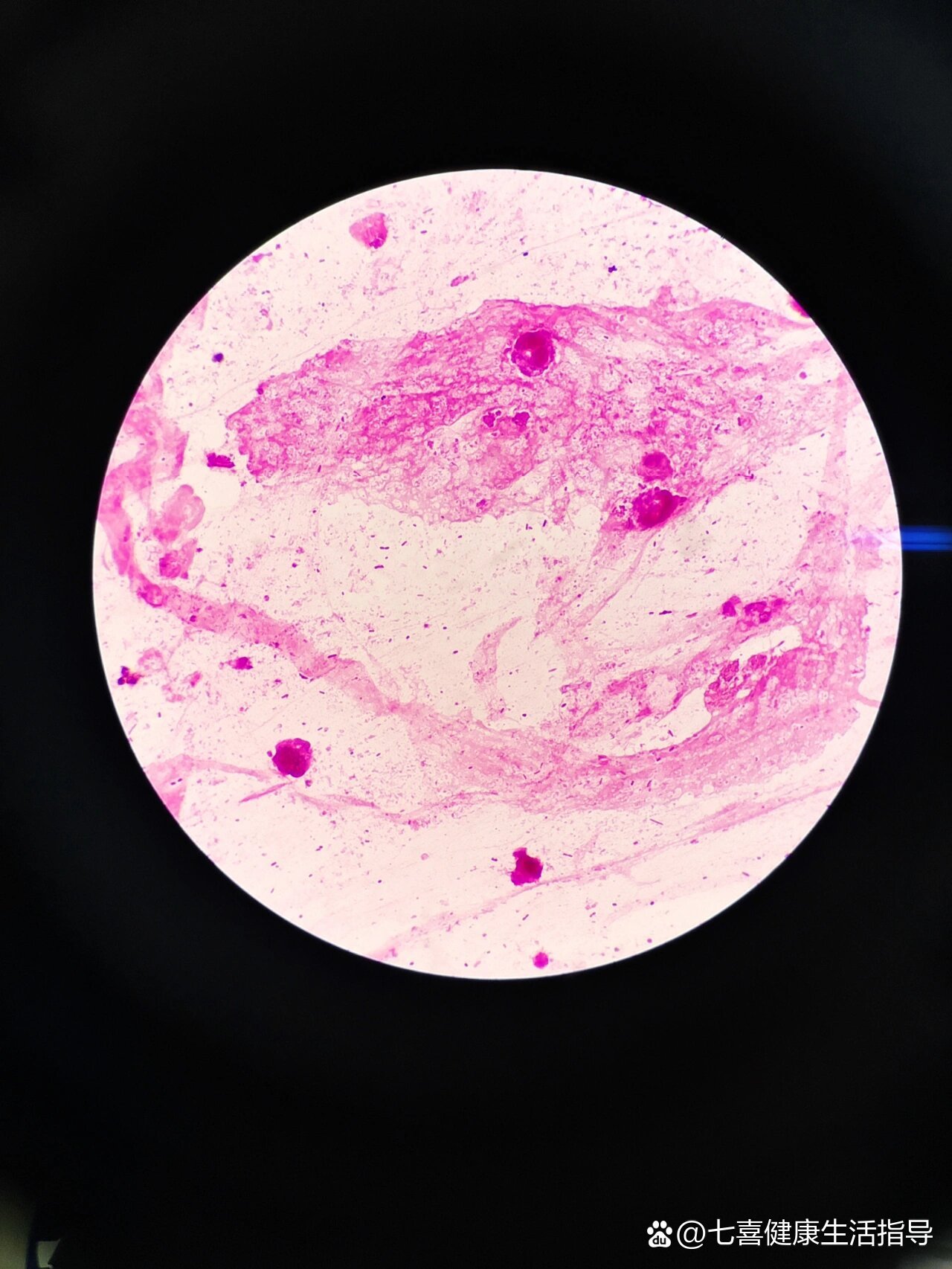 痰涂片抗酸染色图片