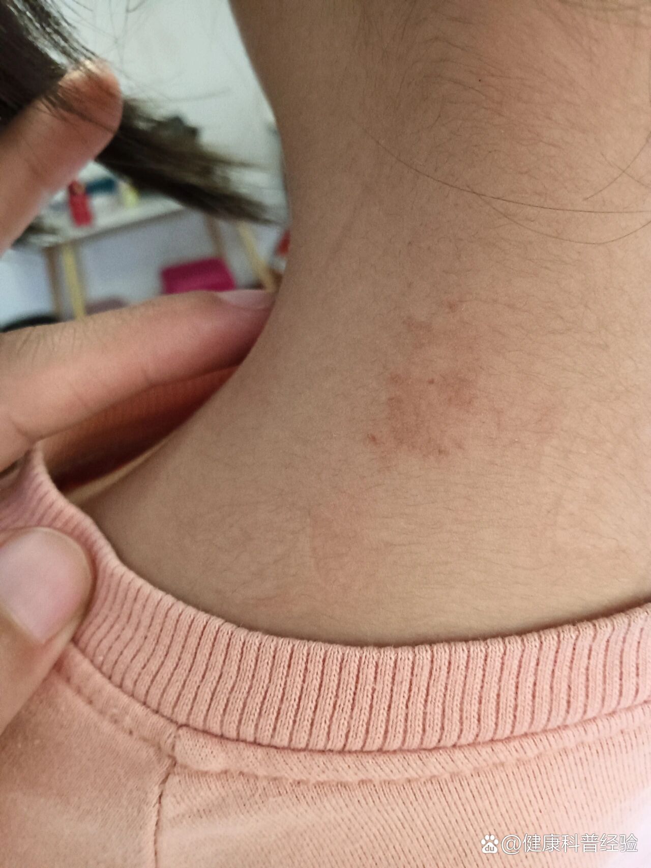 第二次血管瘤激光,对比