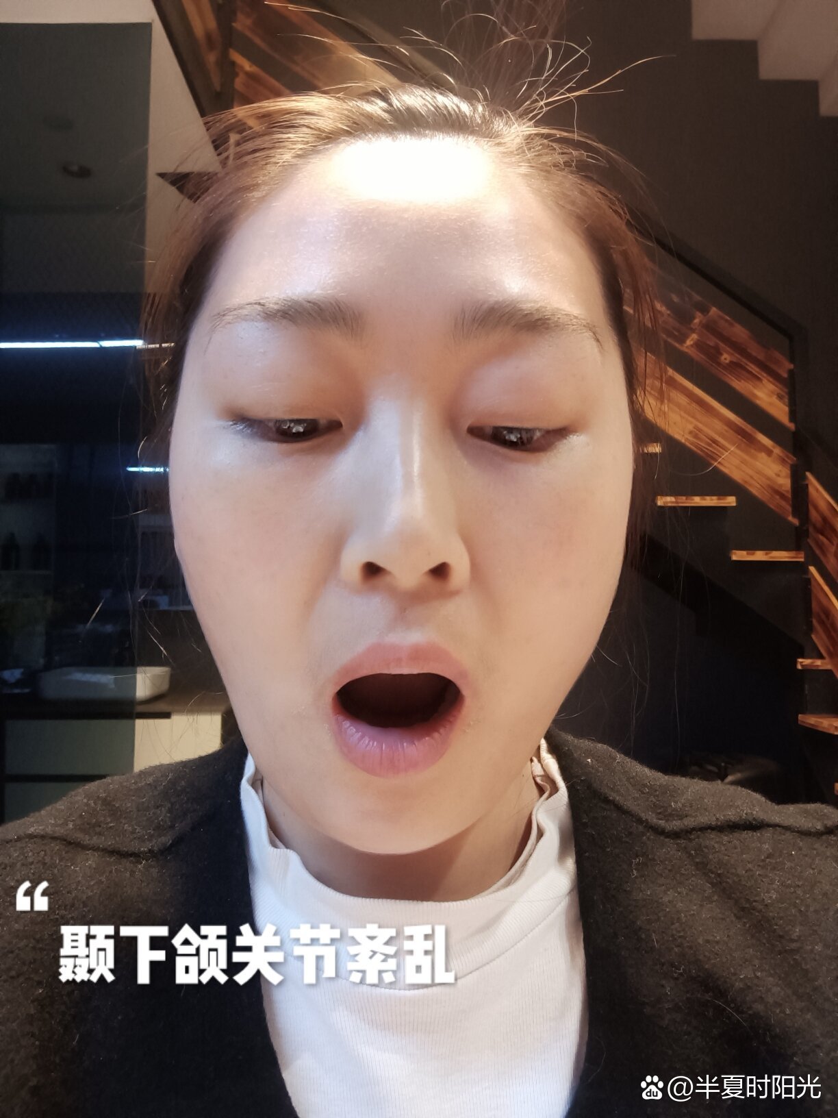  p>颞下颌关节紊乱综合征 br>病症:大小脸,张嘴时歪脸,有咯吱声,伴有